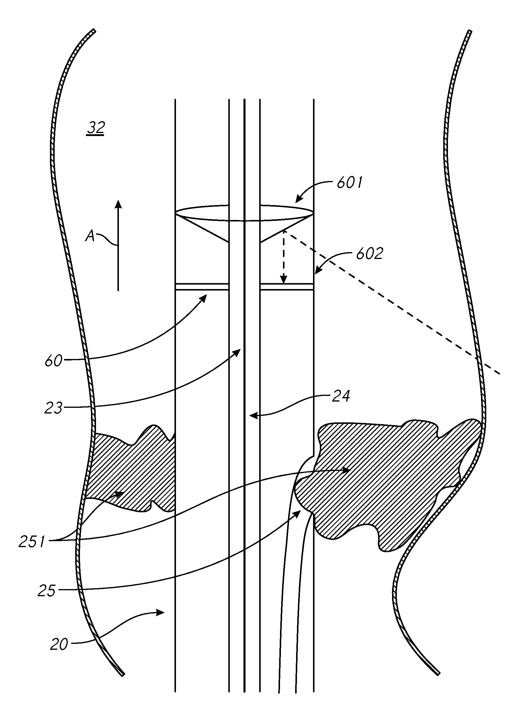 Devices and methods for treating lower extremity vasculature