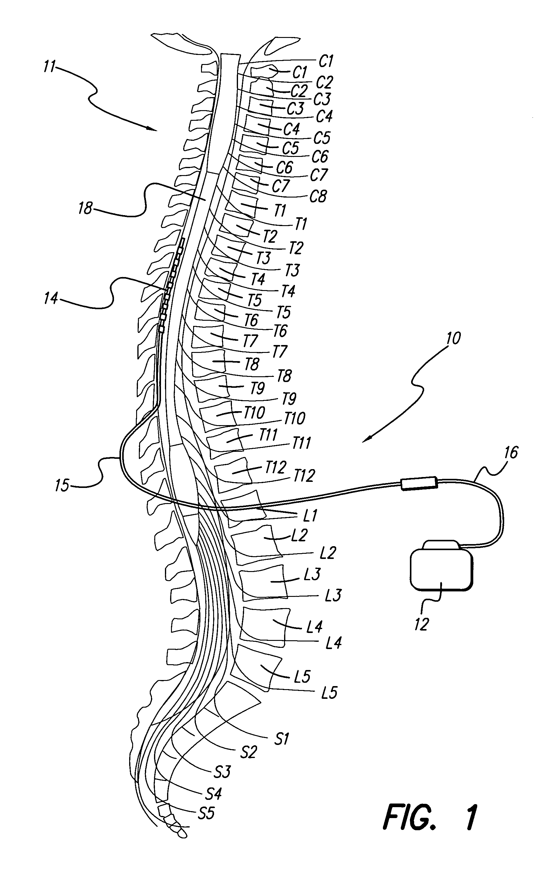 System and method for lead fixation