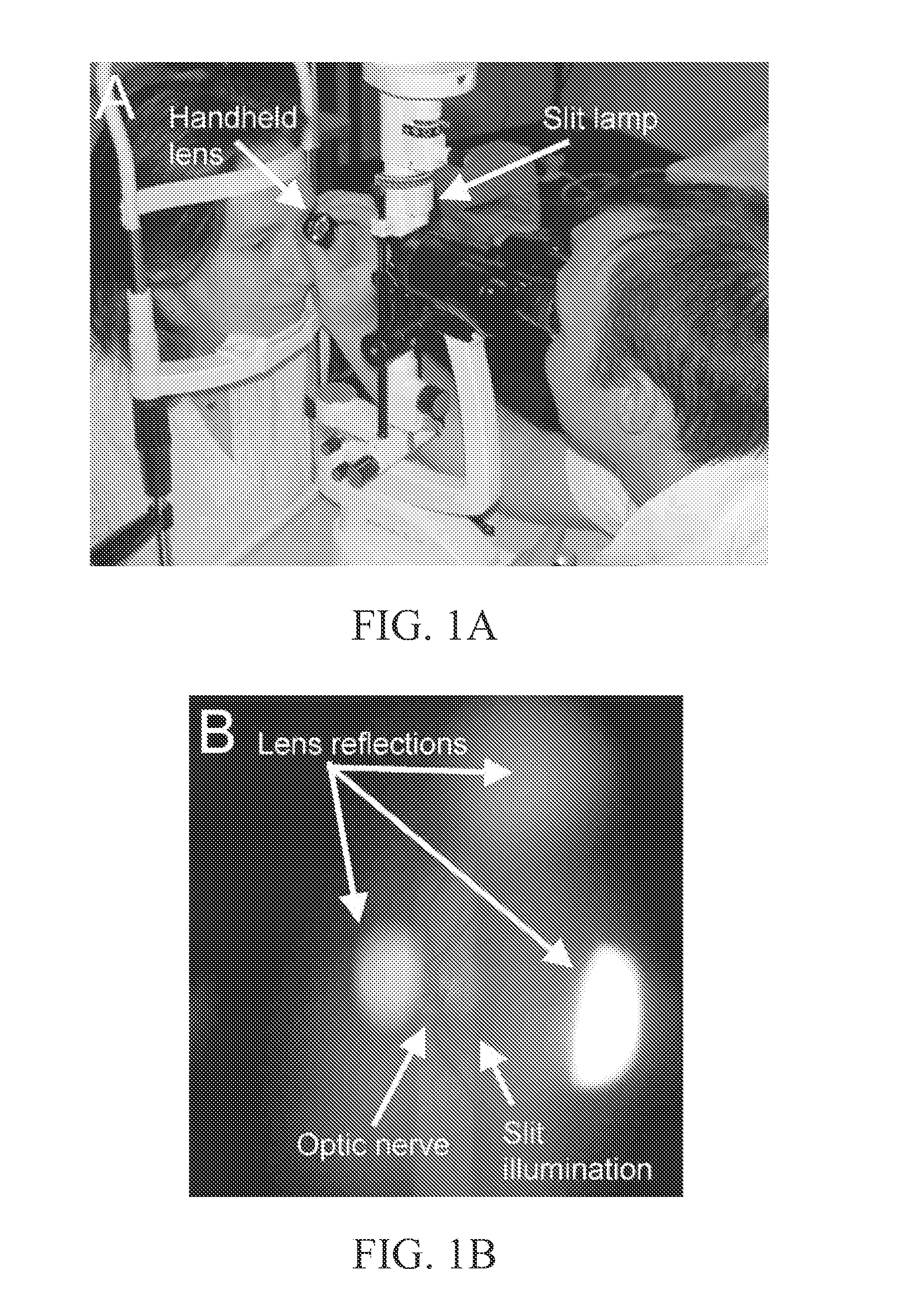 Self-illuminated handheld lens for retinal examination and photography and related method thereof