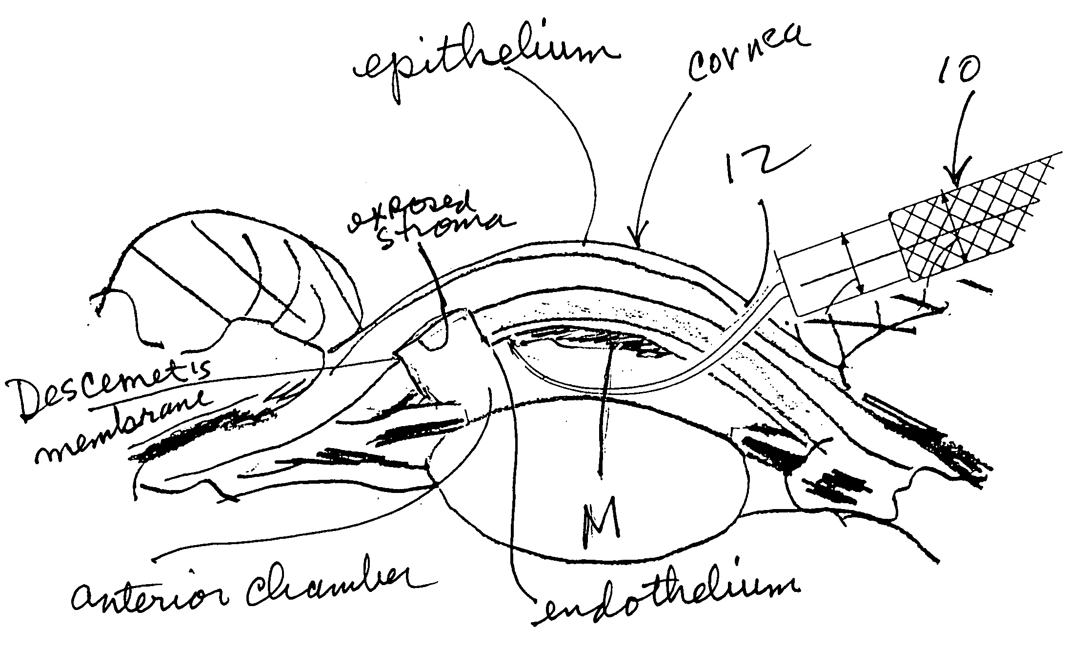 Ophthalmic surgical instrument & surgical methods