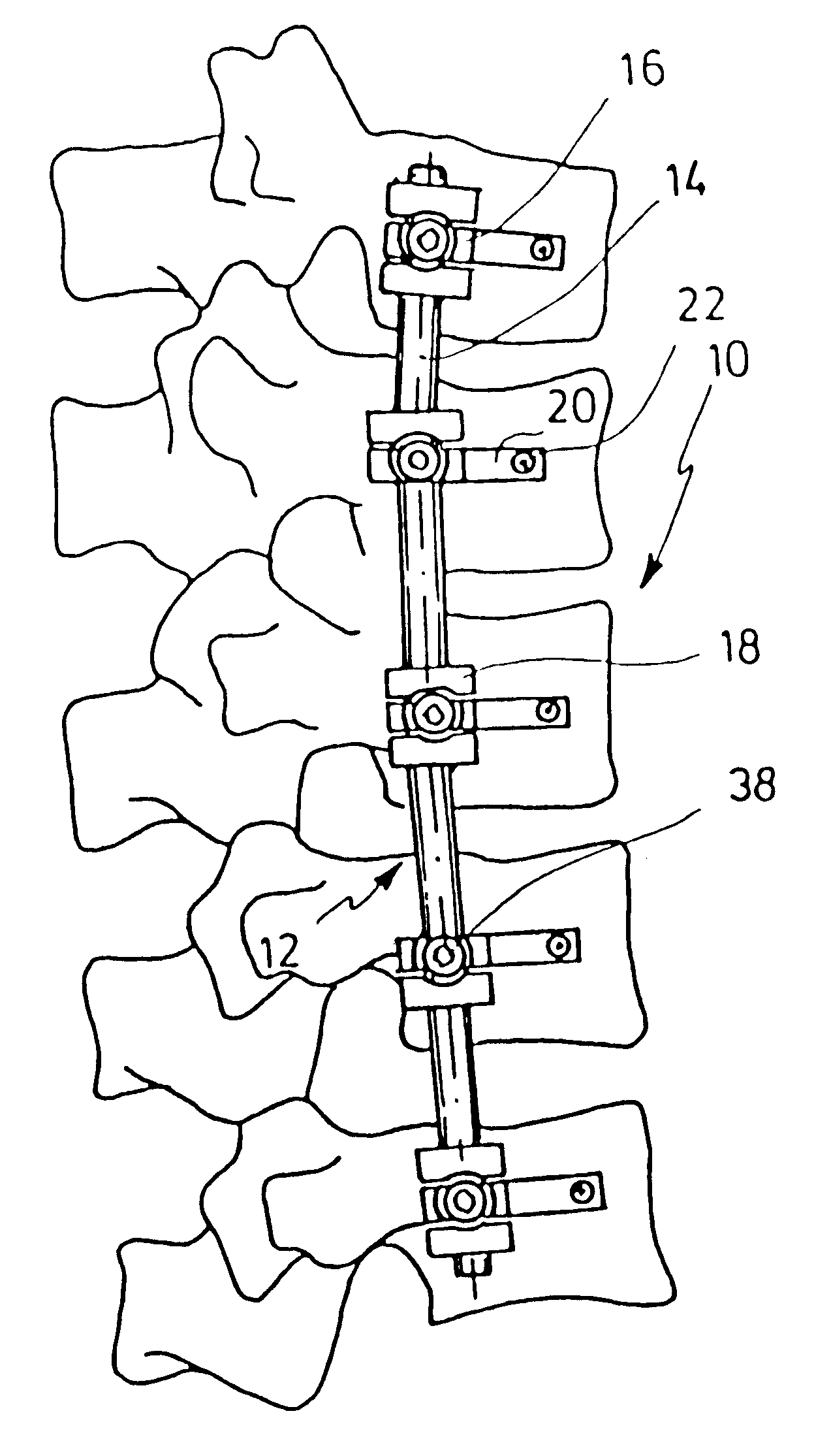 Apparatus for bracing vertebrae