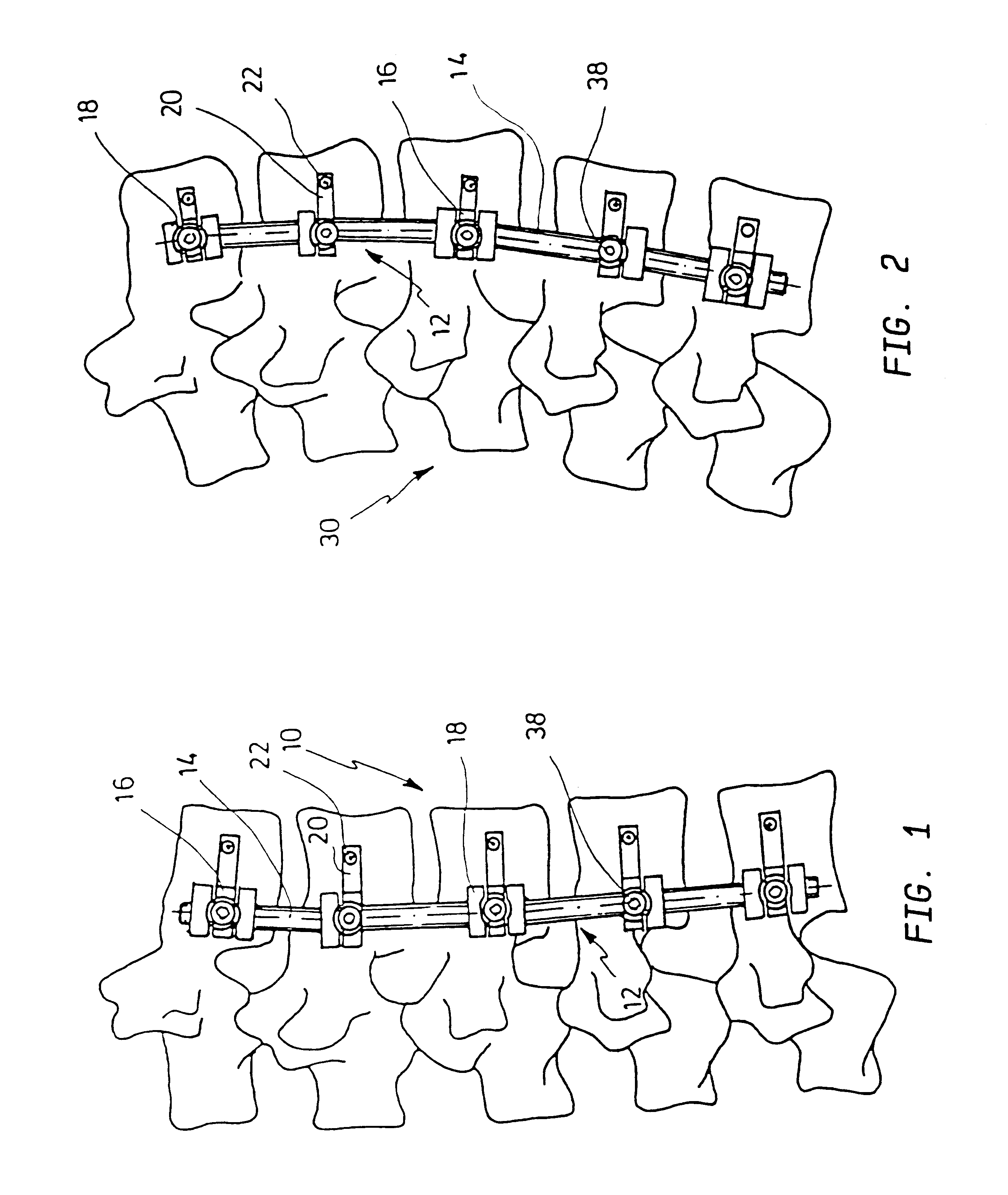 Apparatus for bracing vertebrae