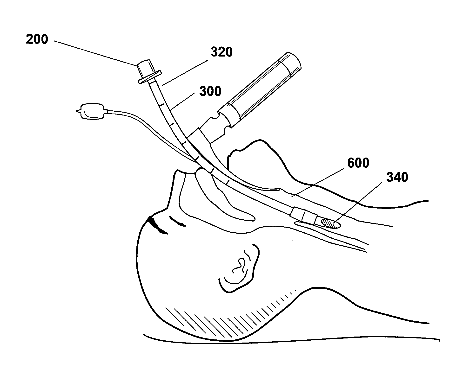 Endotracheal tube connector positioning system and method