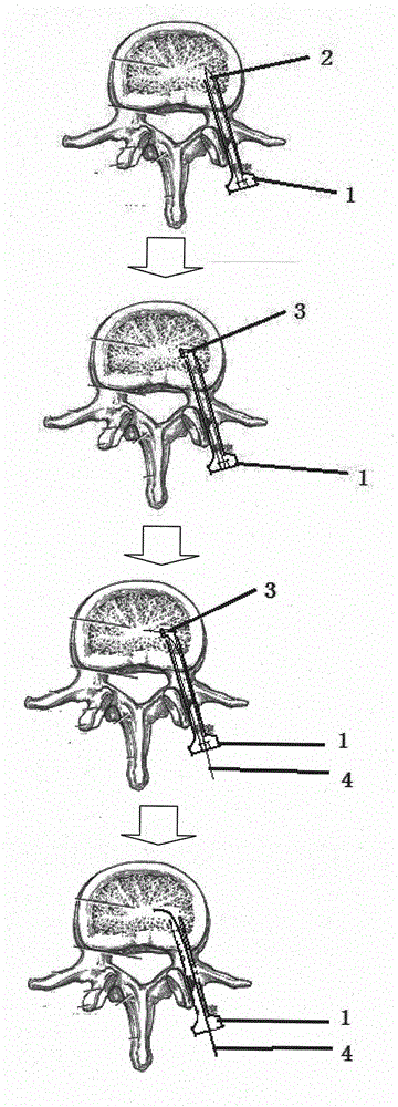 Percutaneous puncture transverse balloon distraction percutaneous kyphoplasty surgical instrument