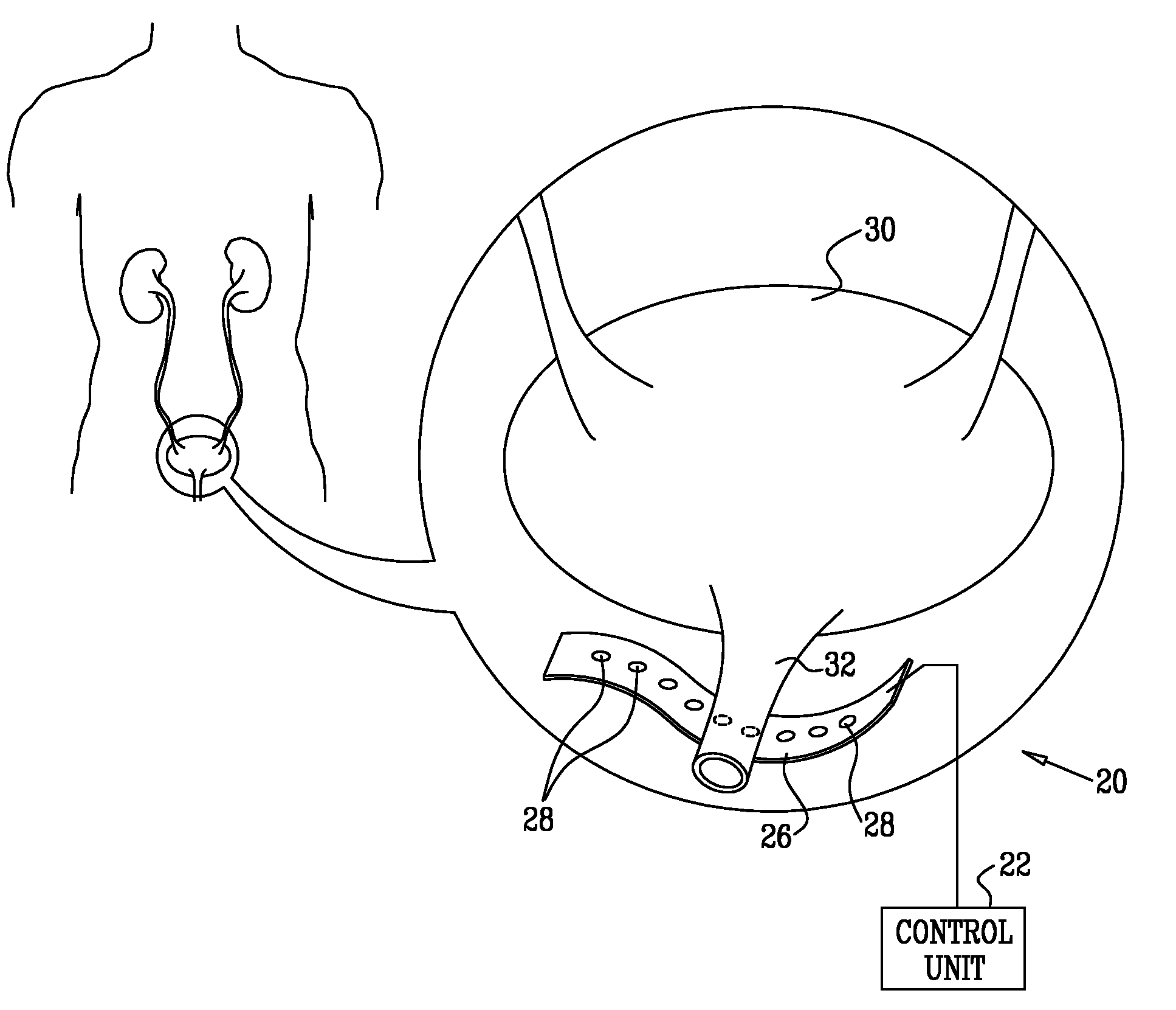 Electrode Sling for Treating Stress and Urge Incontinence