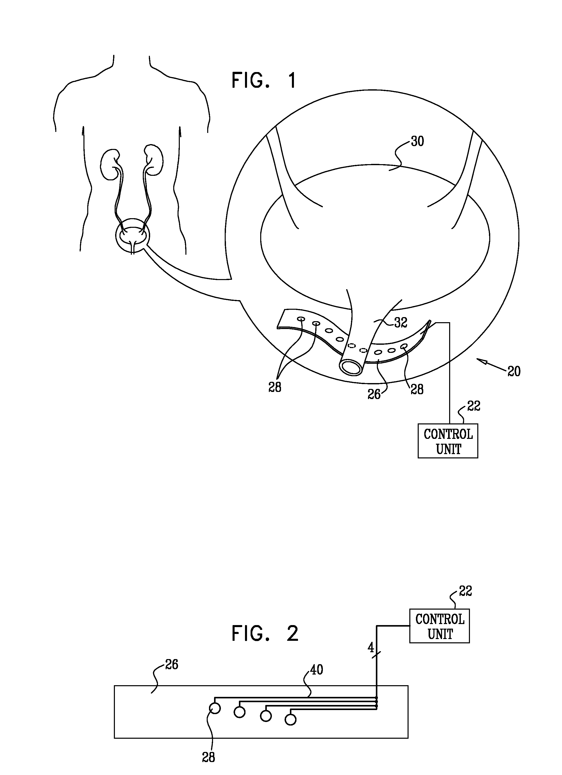 Electrode Sling for Treating Stress and Urge Incontinence