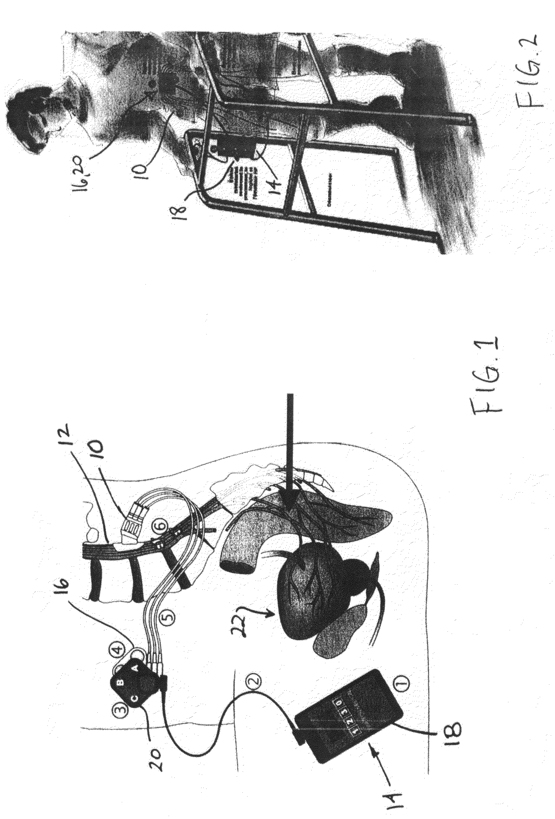 Laparoscopic implantation of neurostimulators