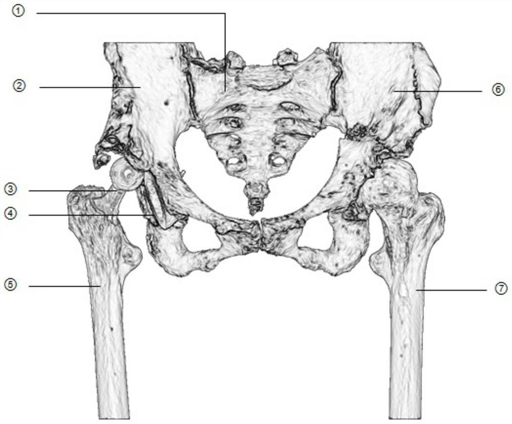 Preoperative planning method for hip joint revision surgery