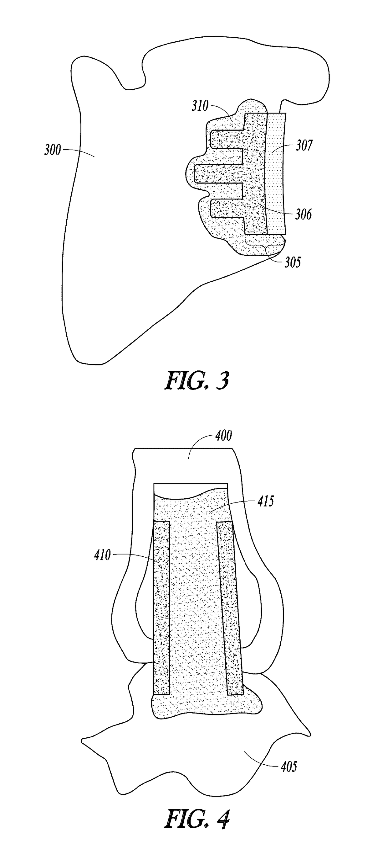 Curable calcium phosphate compositions for use with porous structures and methods of using the same