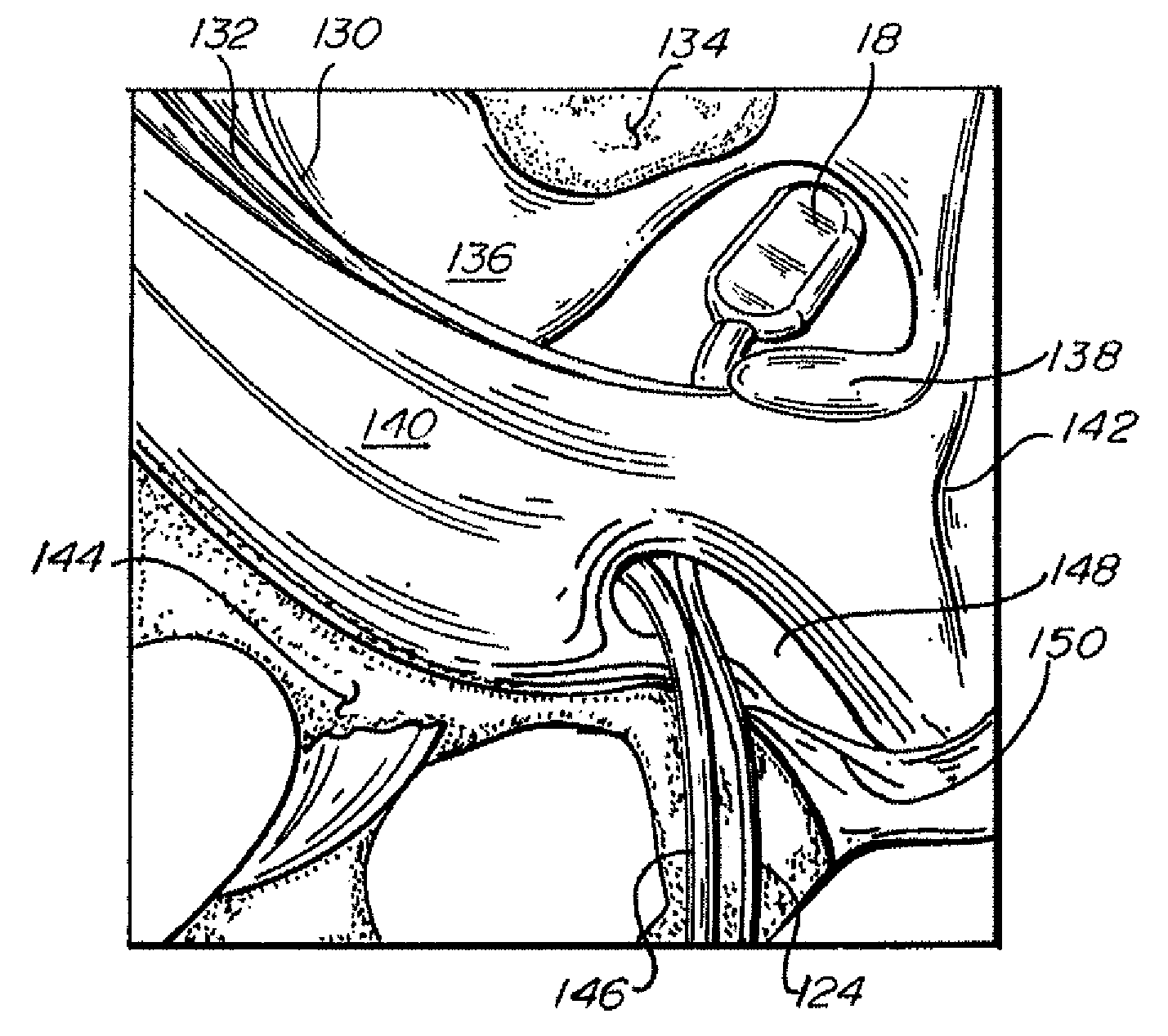 Fluid reservoir for penile implant devices