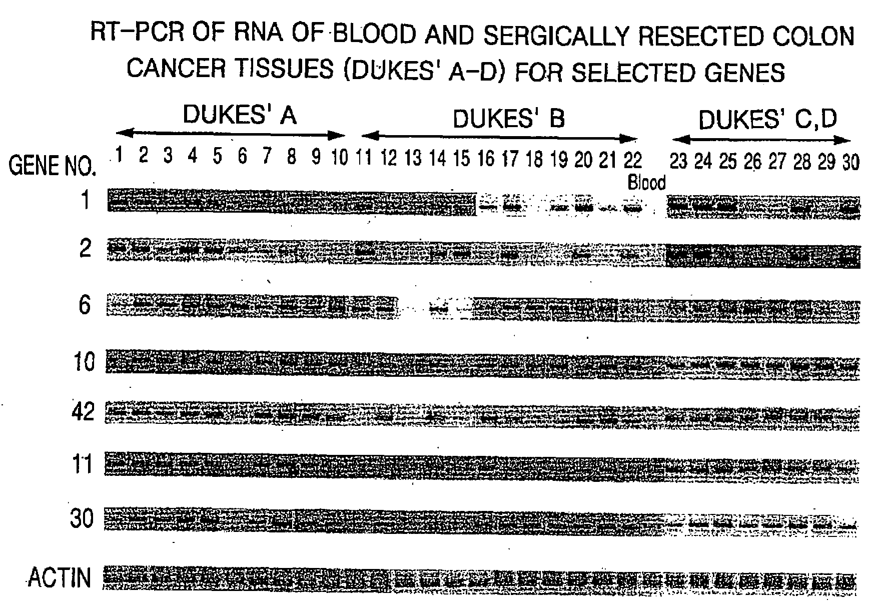 Method for screening colon cancer cells and gene set used for examination of colon cancer