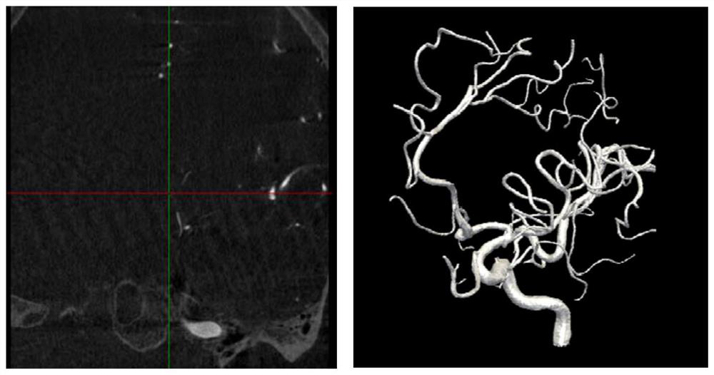 A method and system for image segmentation of intracranial arteries