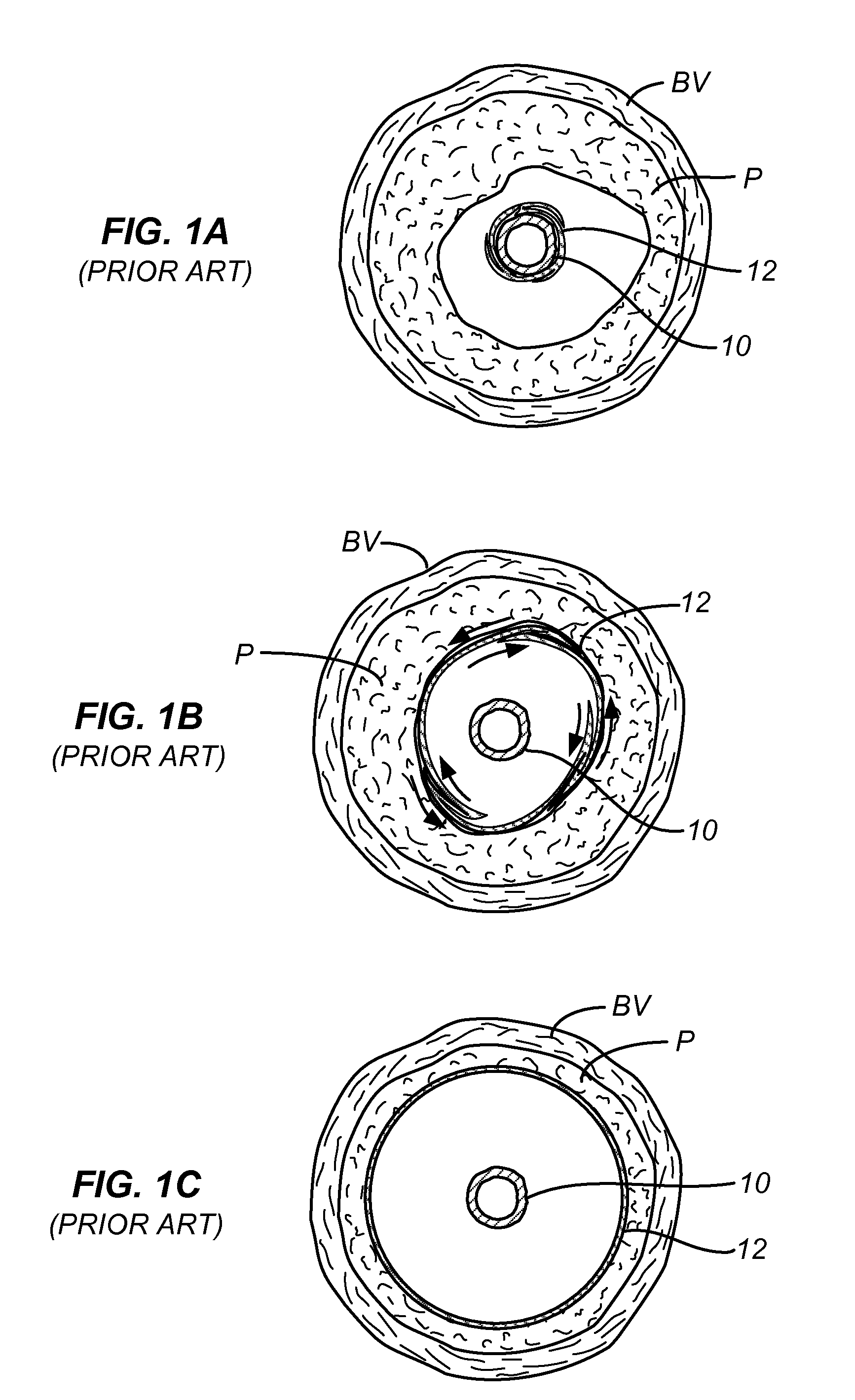 Device and method for compartmental vessel treatment