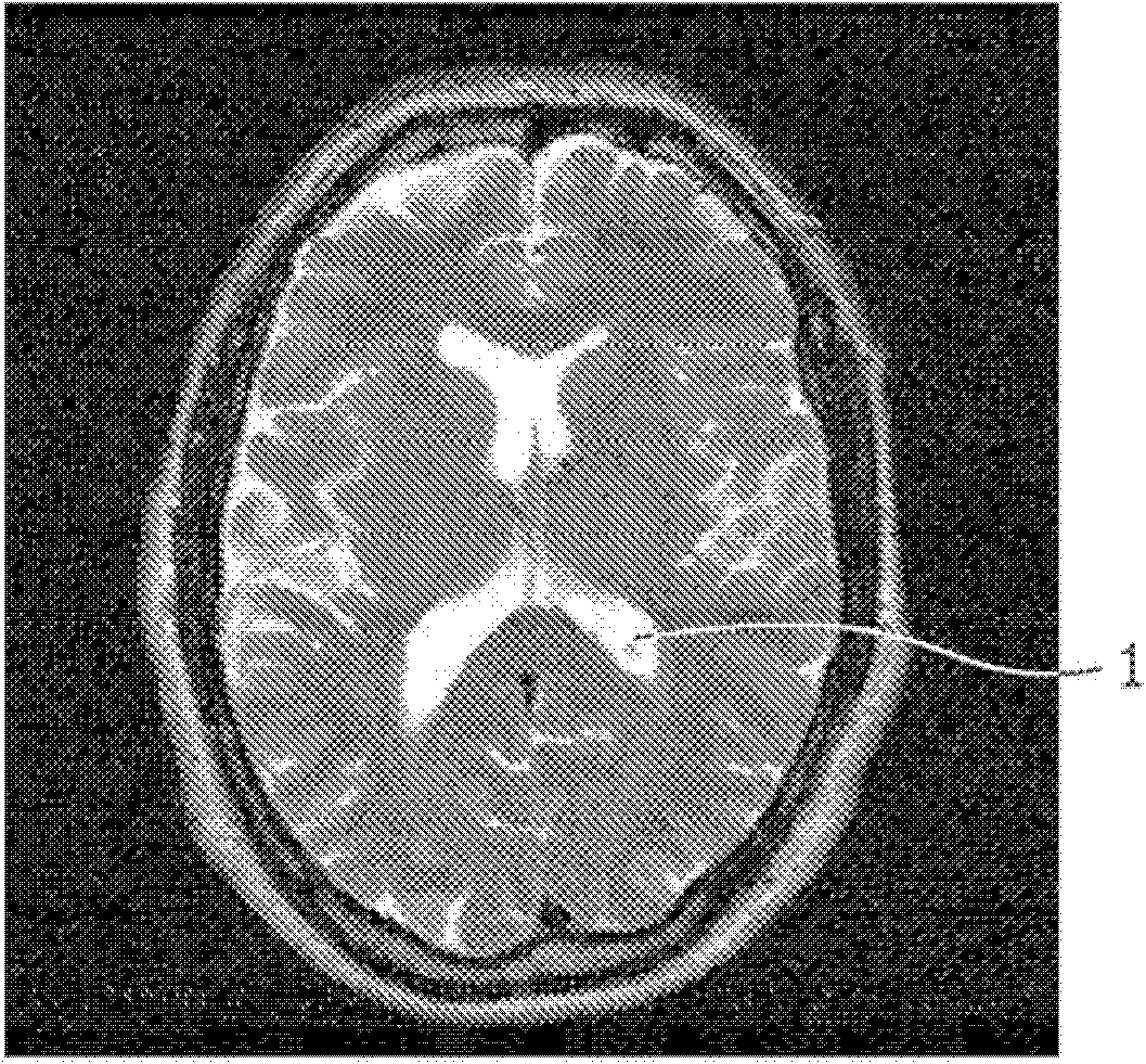 Brain ventricle analysis