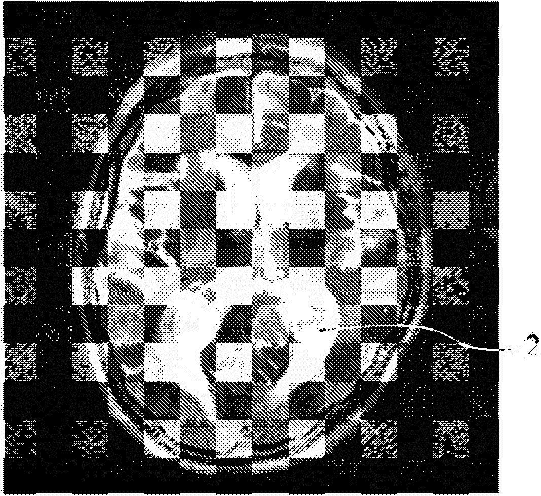 Brain ventricle analysis