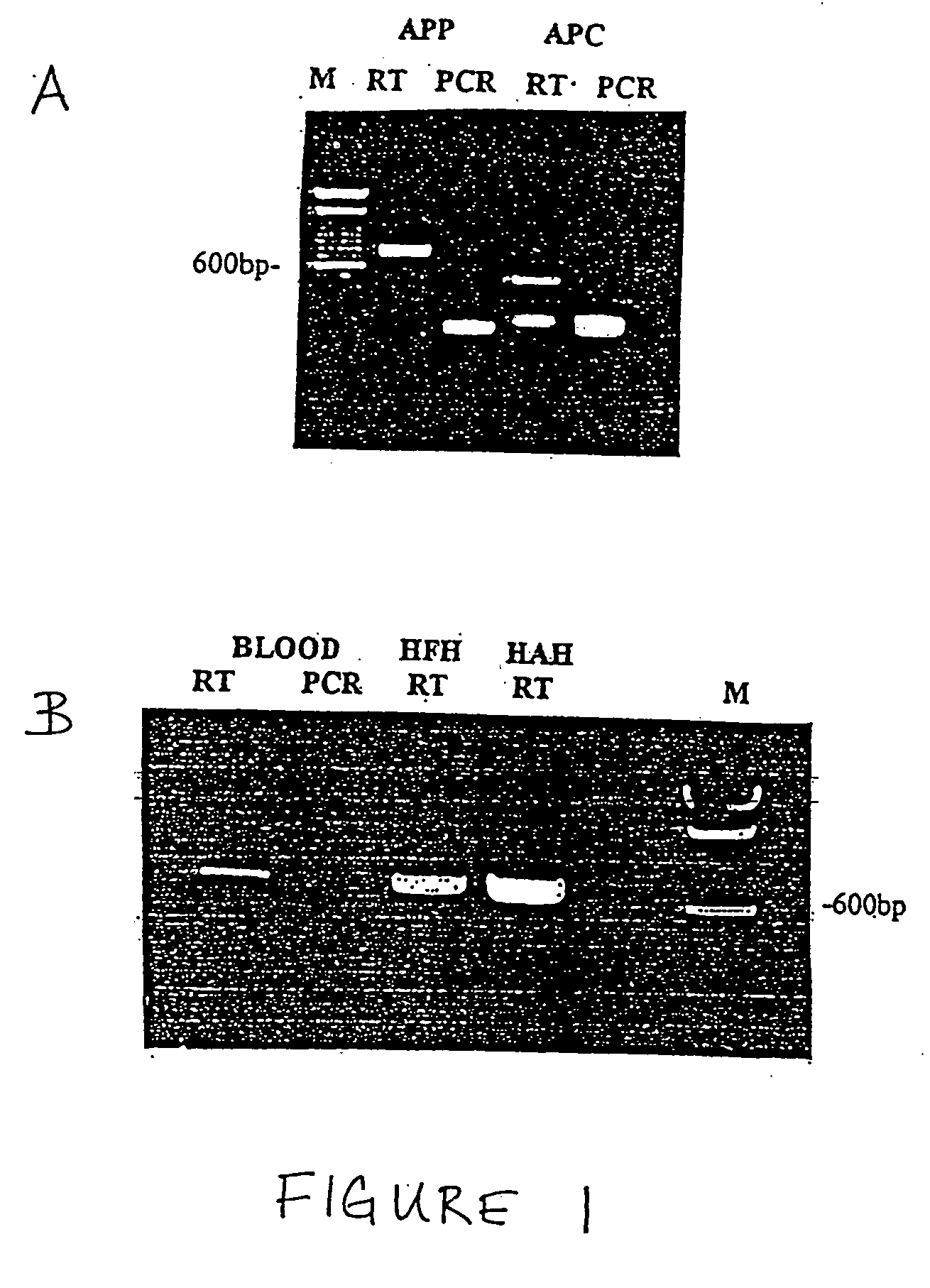 Method for the detection of cancer related gene transcripts in blood