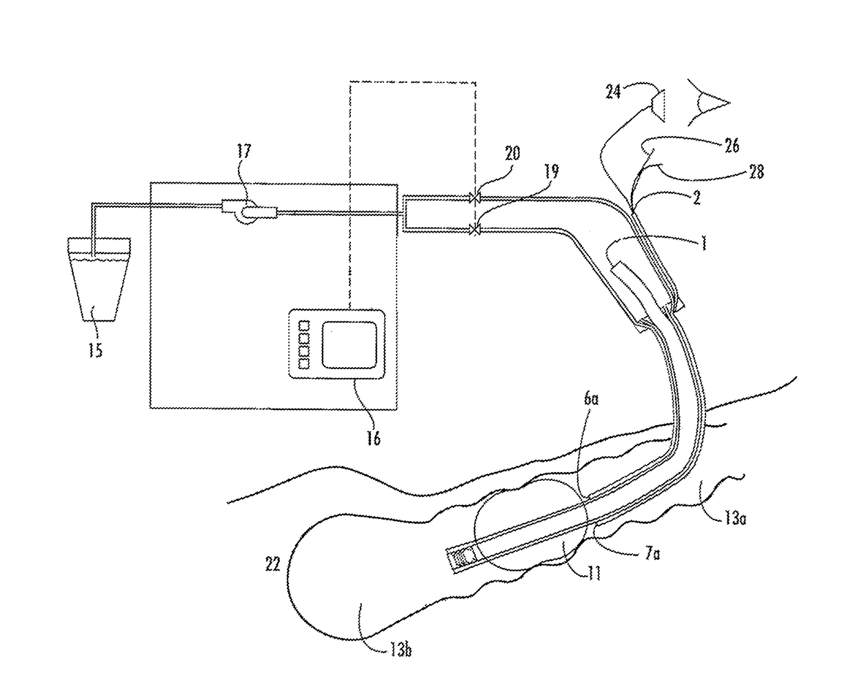 Non-invasive method of diagnosing dysphagia in patients having a tracheostomy