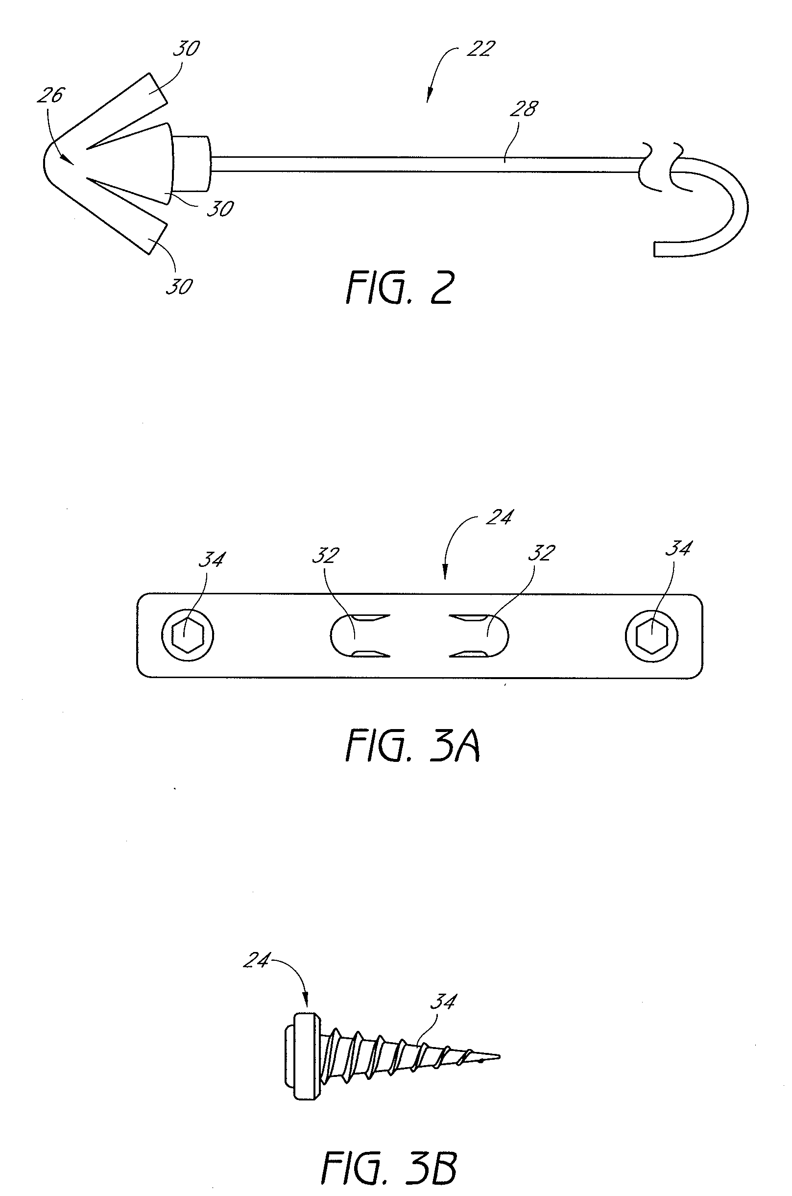 System and method for temporary tongue suspension