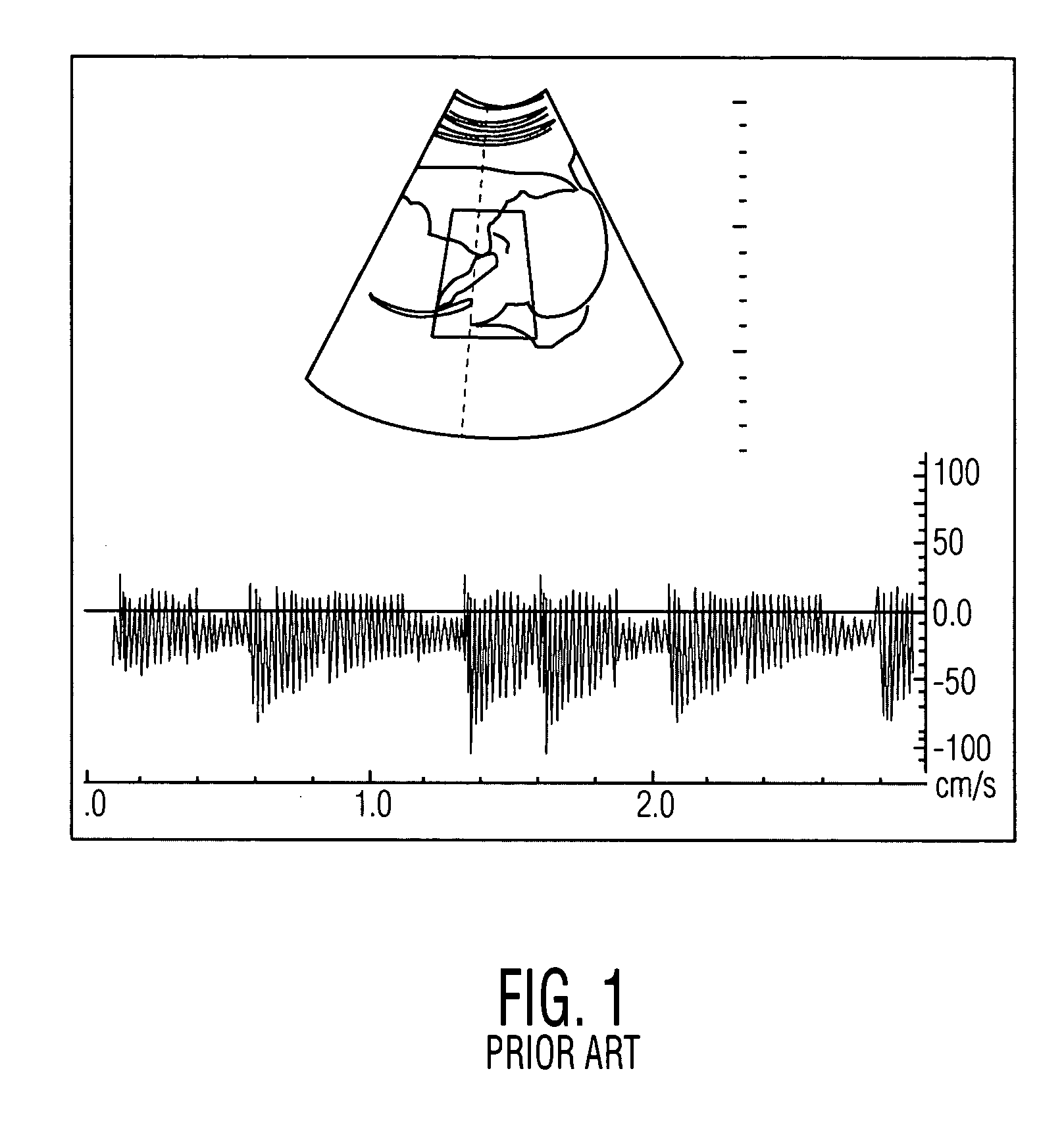 Tracking clutter filter for spectral & audio doppler