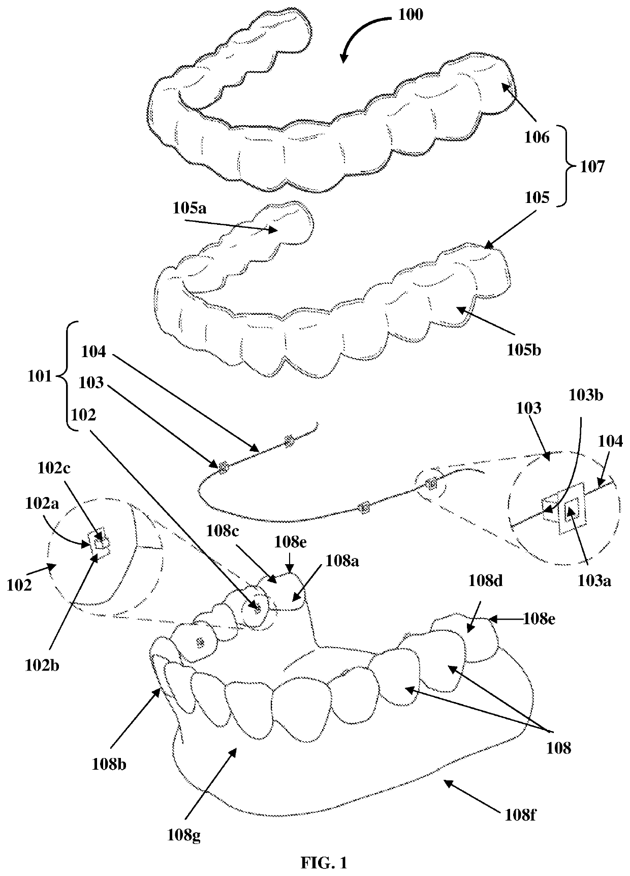 Detachable Orthodontic Bracket And Wire System