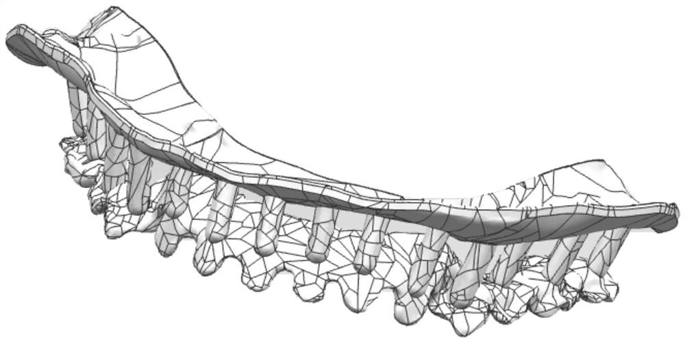 A digital manufacturing method of three-dimensional brackets for complete dentures