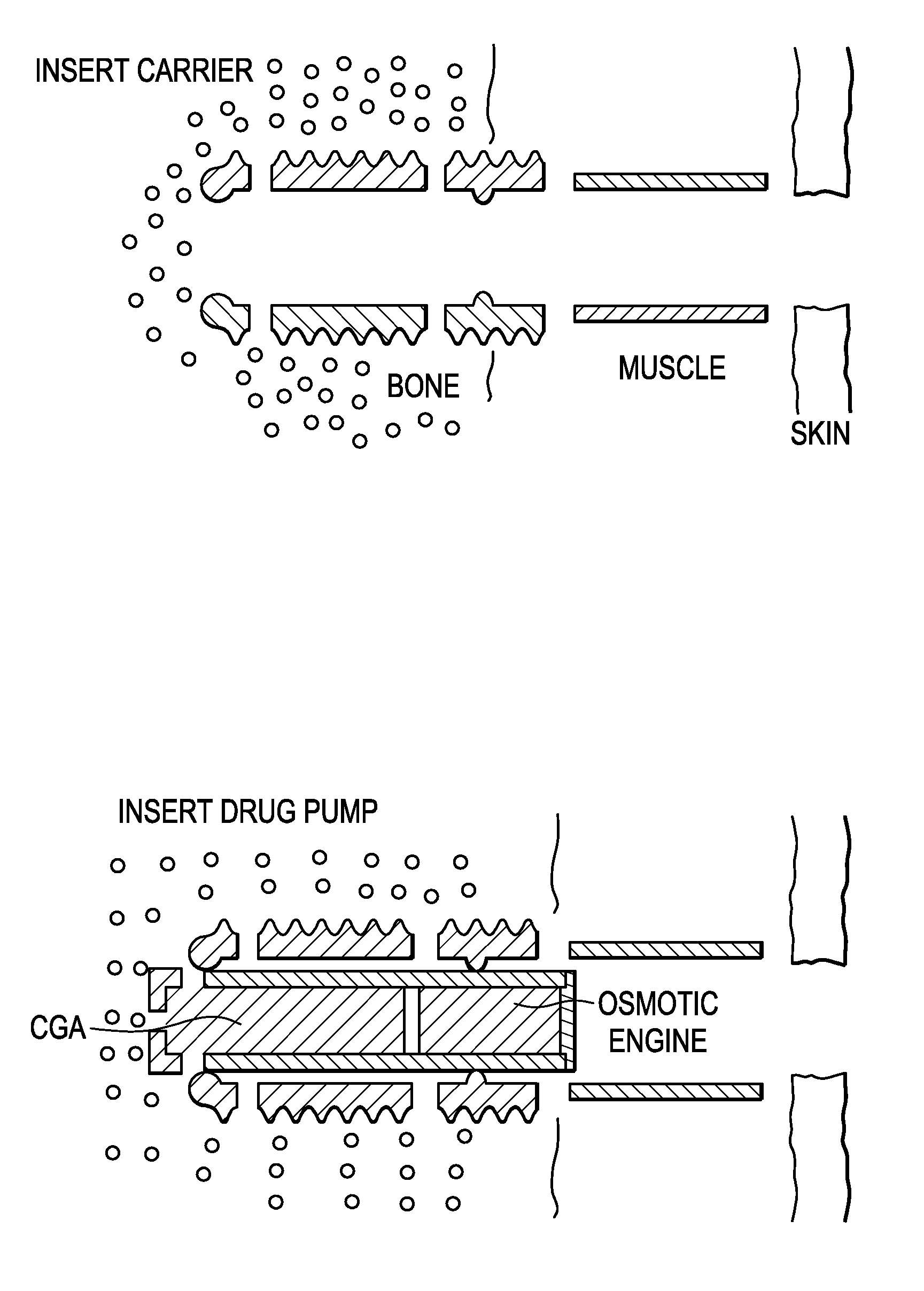 Methods and Devices for Correcting Spinal Deformity With Pharmaceutical-Eluting Pedicle Screws