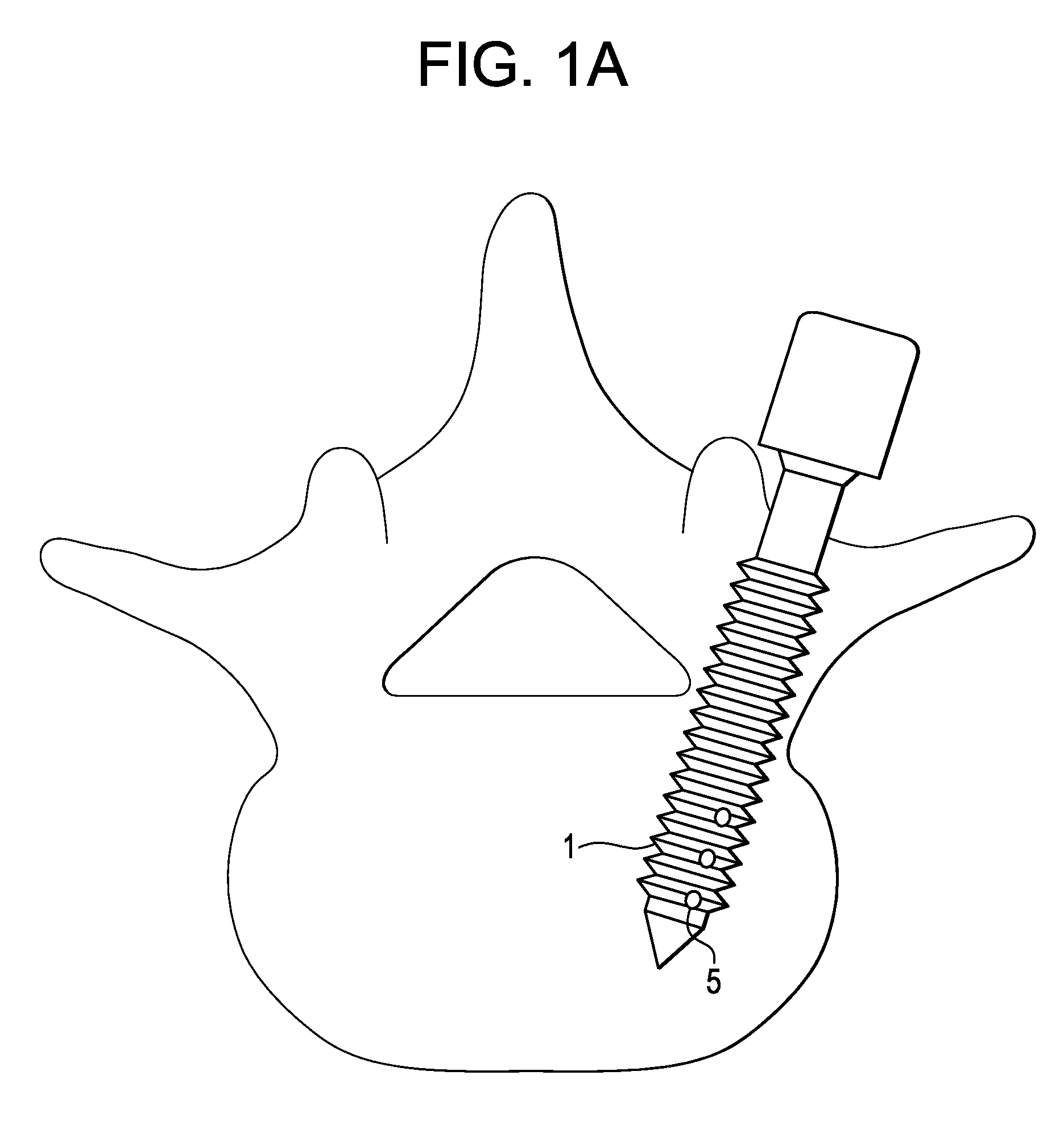 Methods and Devices for Correcting Spinal Deformity With Pharmaceutical-Eluting Pedicle Screws