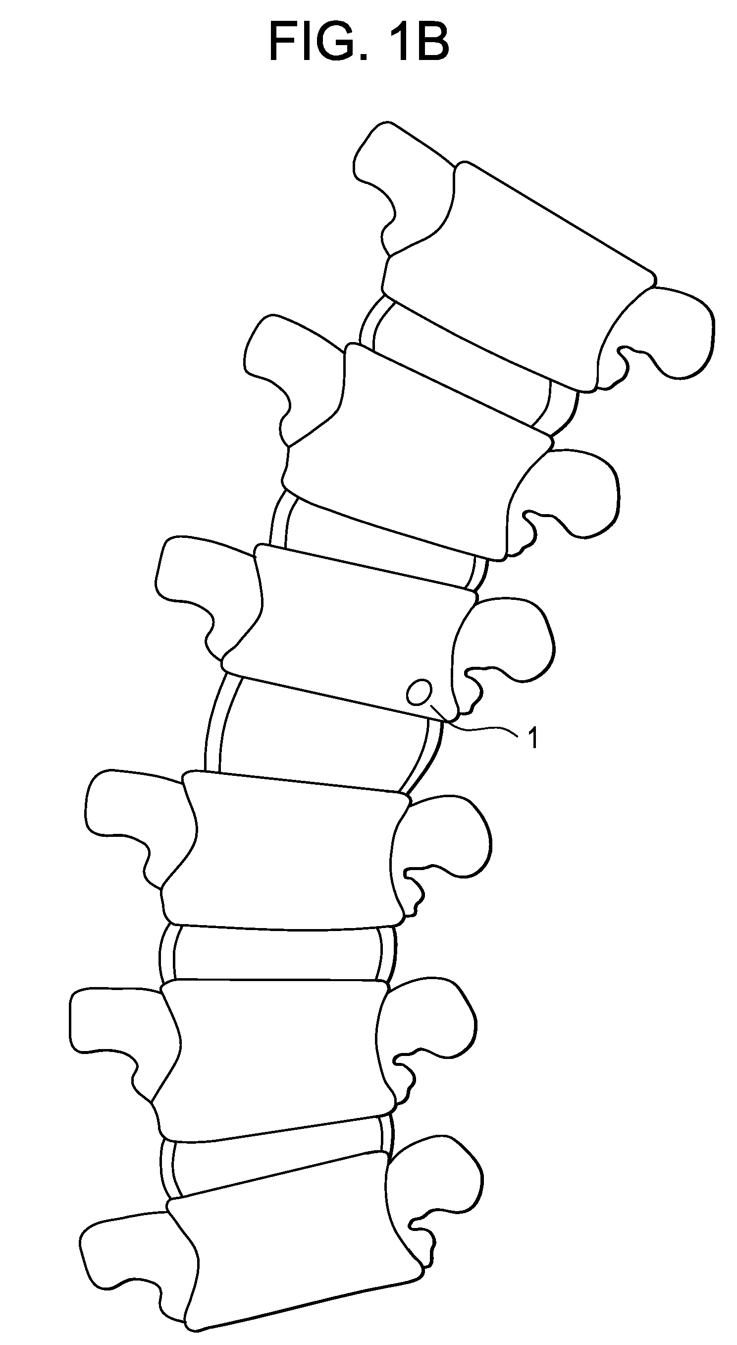 Methods and Devices for Correcting Spinal Deformity With Pharmaceutical-Eluting Pedicle Screws