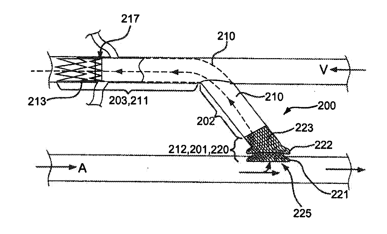 Anastomotic devices and methods