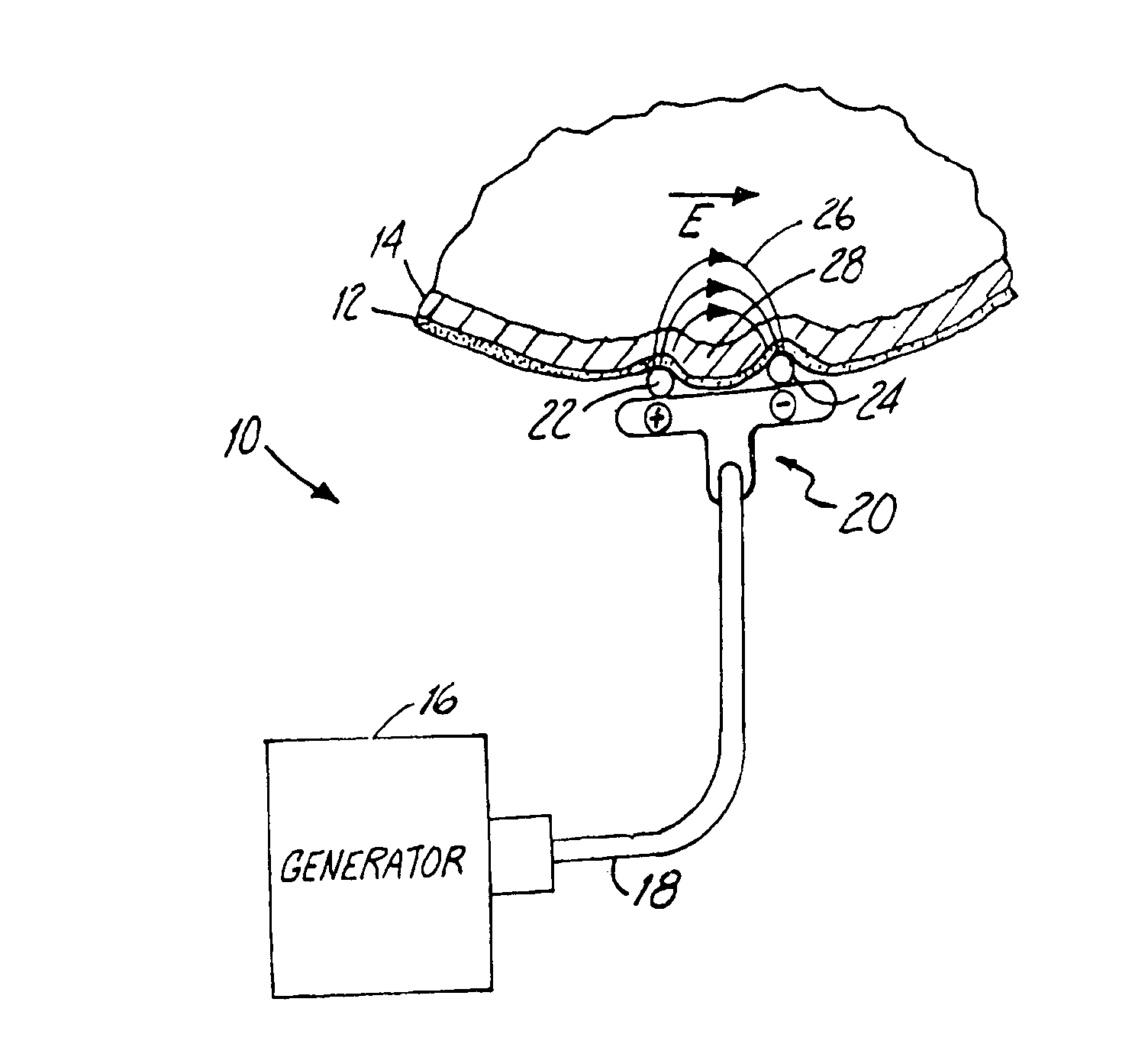 Apparatus and Method for Reducing Subcutaneous Fat Deposits, Virtual Face Lift and Body Sculpturing by Electroporation