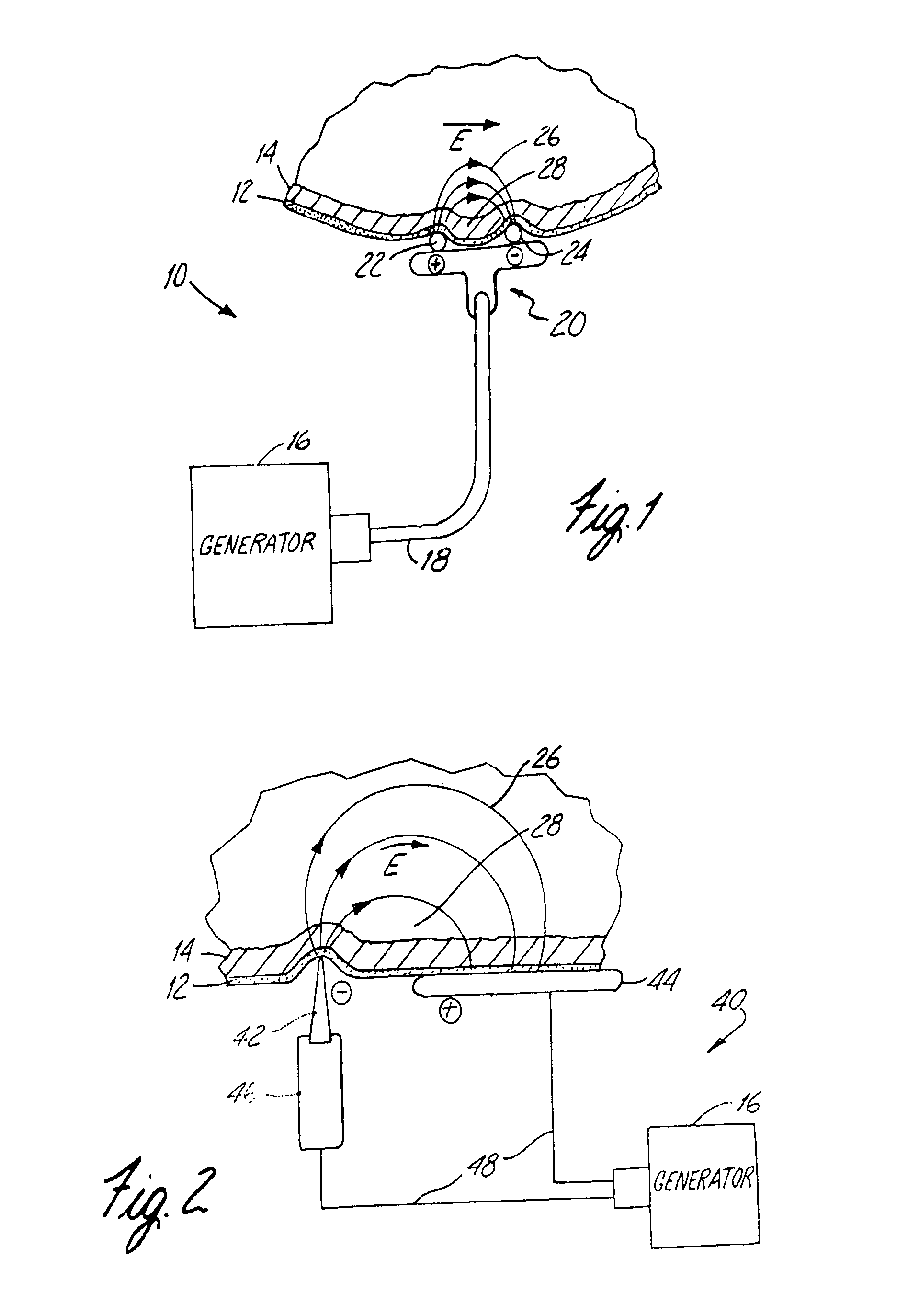 Apparatus and Method for Reducing Subcutaneous Fat Deposits, Virtual Face Lift and Body Sculpturing by Electroporation