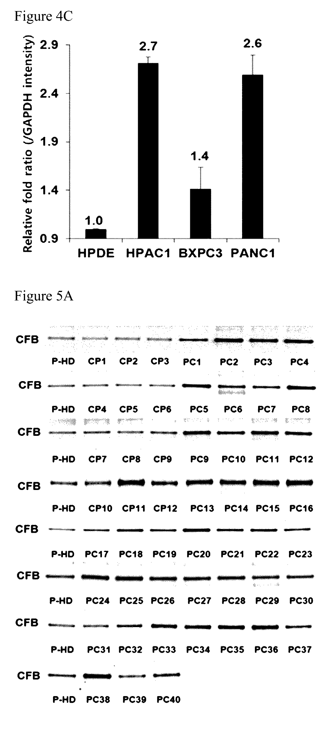 Kit comprising antibody specifically binding to complement factor b protein and antibody specifically binding to carbohydrate antigen 19-9 protein for diagnosing pancreatic cancer