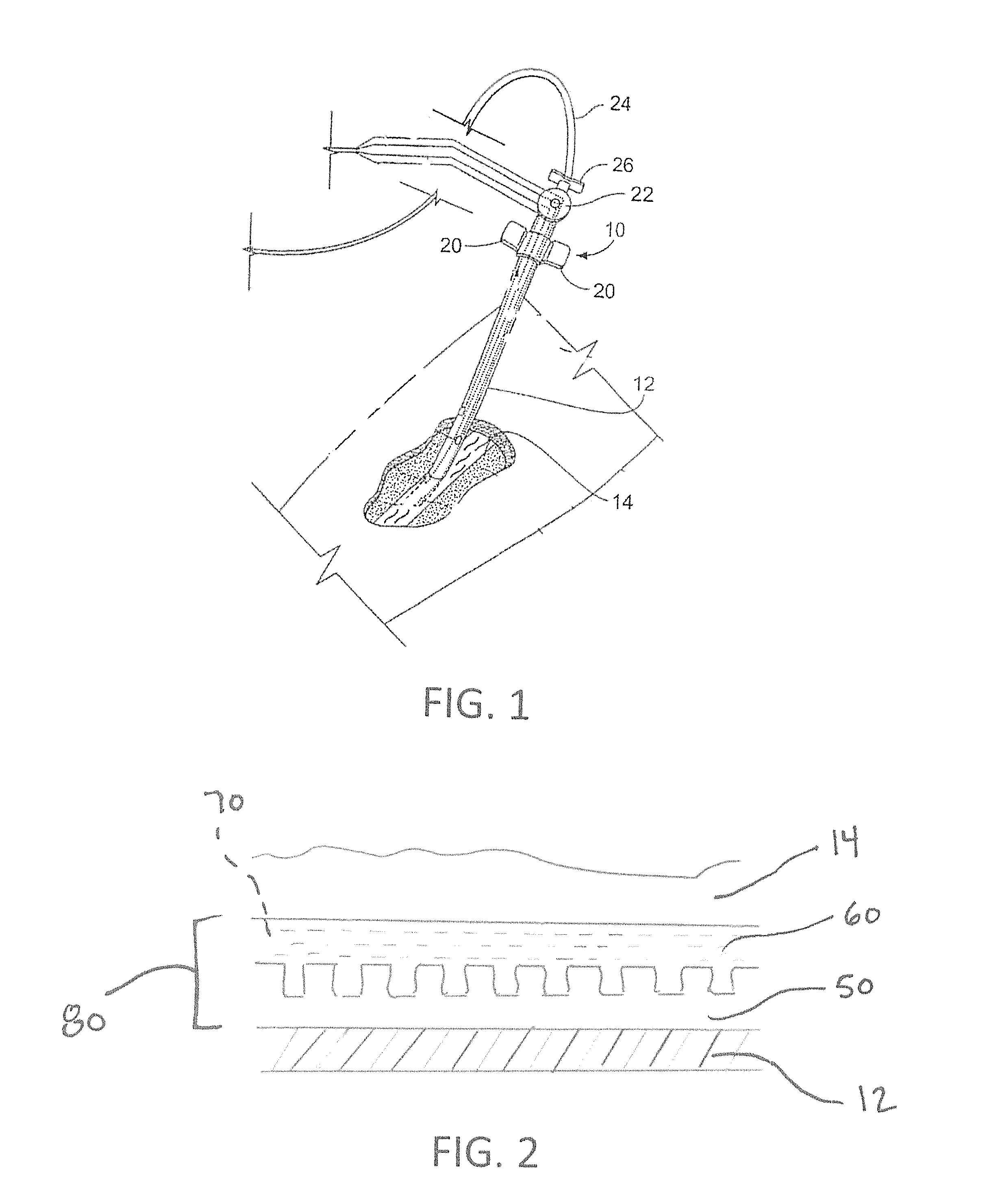 Coated medical apparatus and methods