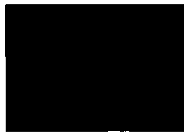 Sugar water gel liquid emboliaztion agent for hemangioma cure and preparation method thereof