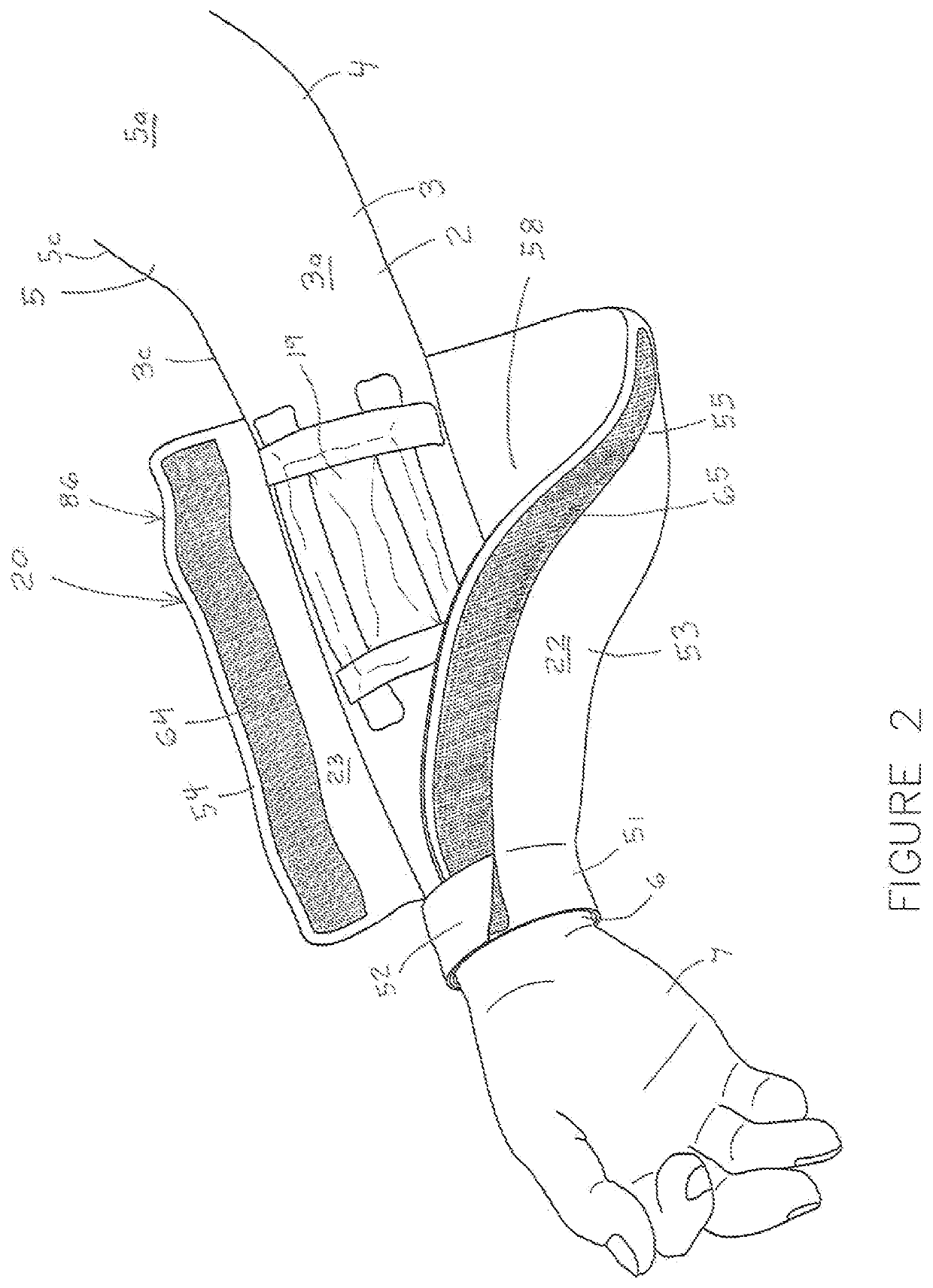 Fistula Sleeve