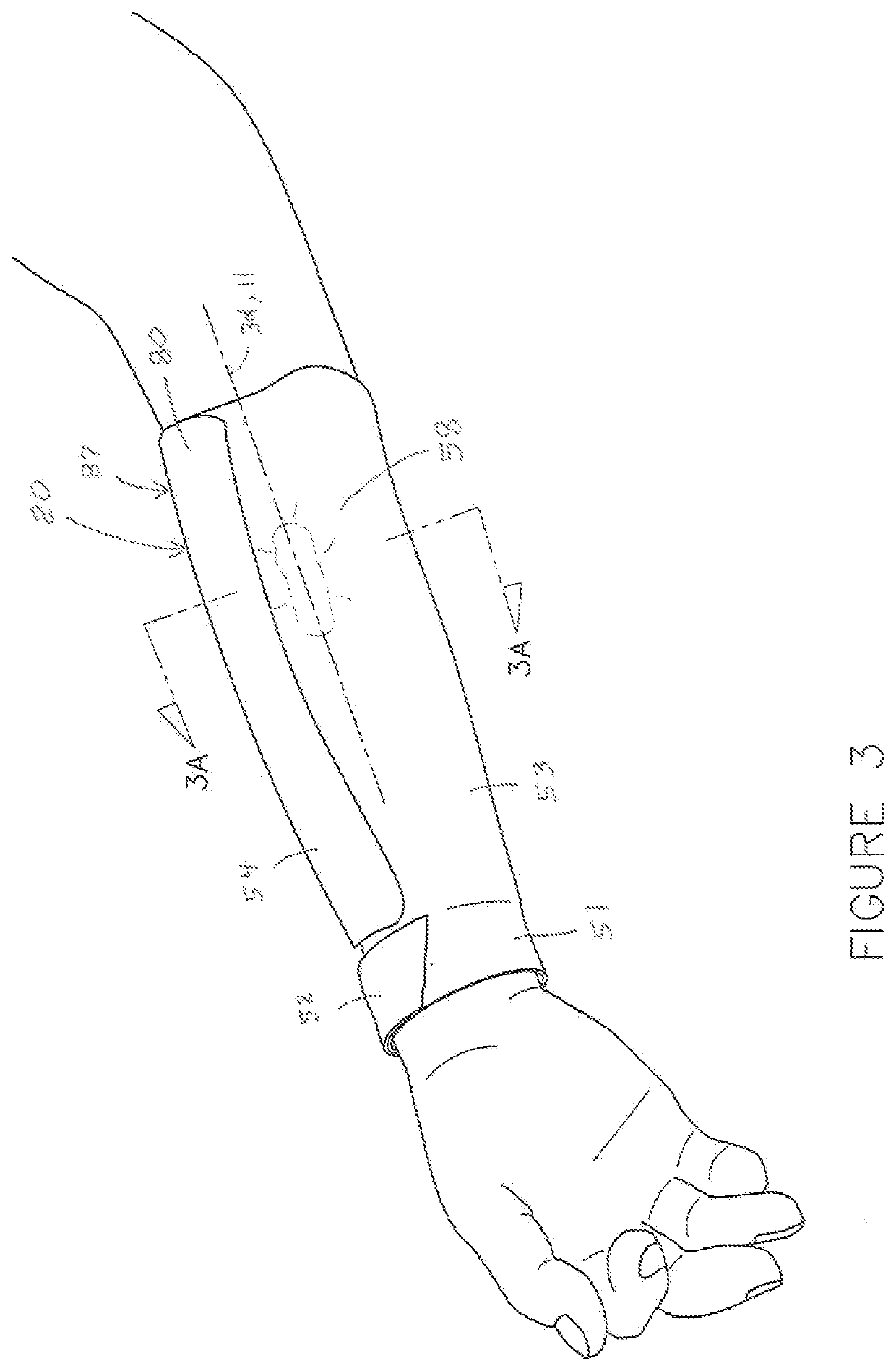 Fistula Sleeve