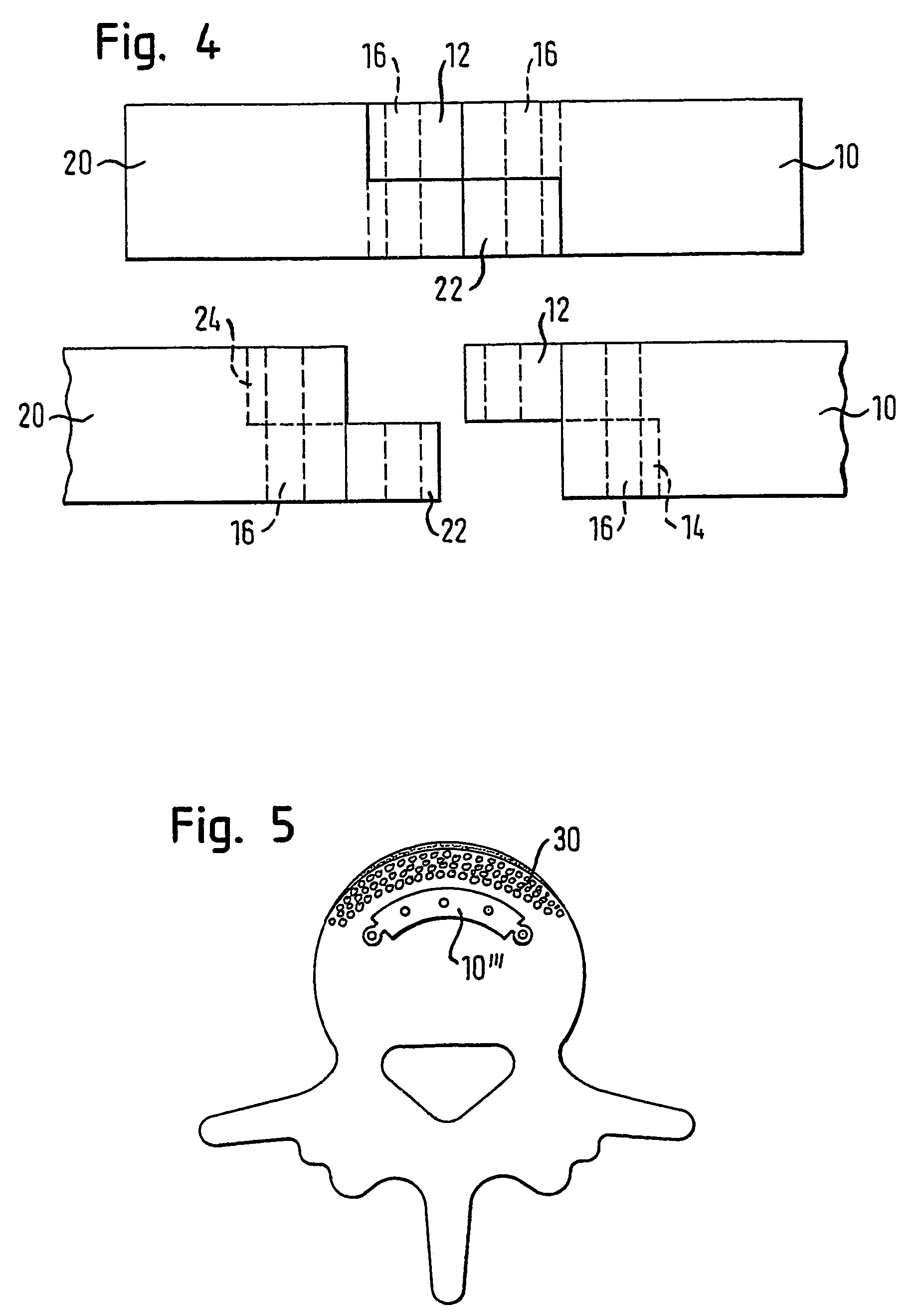 Modular system for spinal column fusion