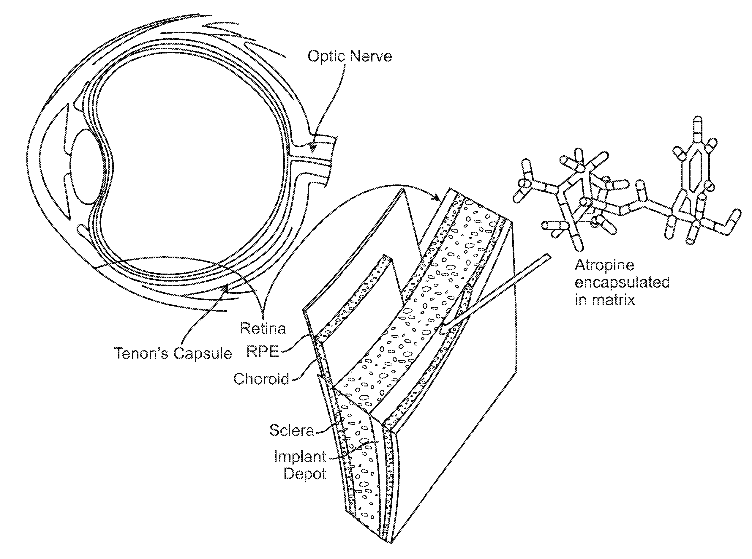 Implantable Delivery Vehicle for Ocular Delivery of Muscarinic Antagonists