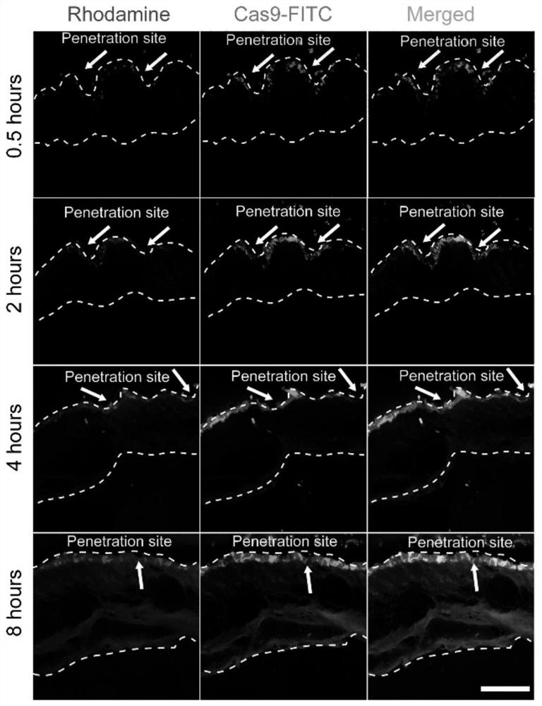 Gene editing microneedle for treating inflammatory skin diseases and application thereof