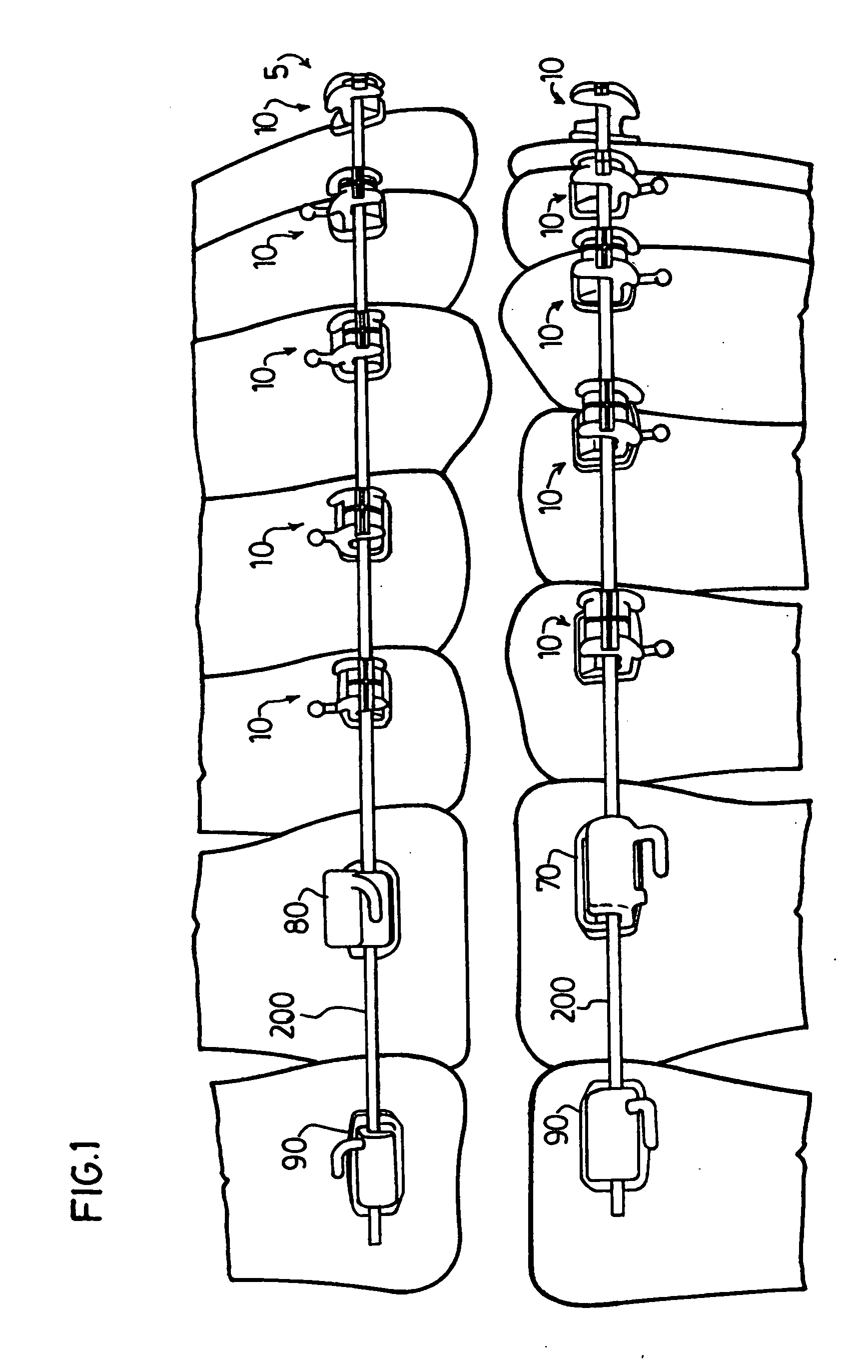 Orthodontic bracket system