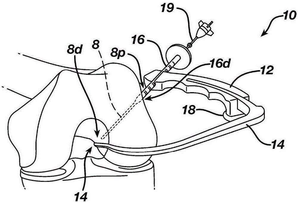 Surgical Guide for Use in Ligament Repair Procedures