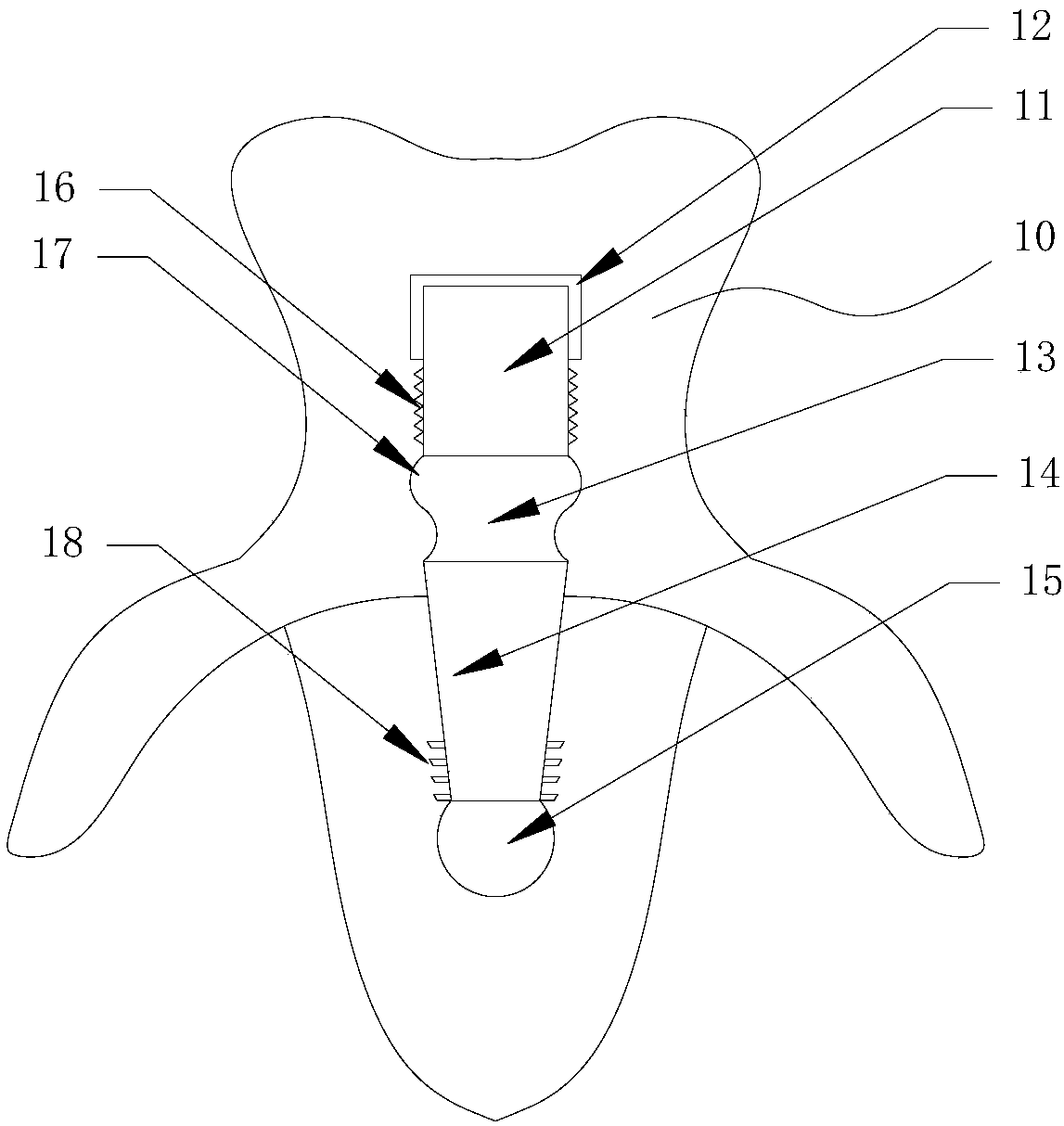 Denture abutment