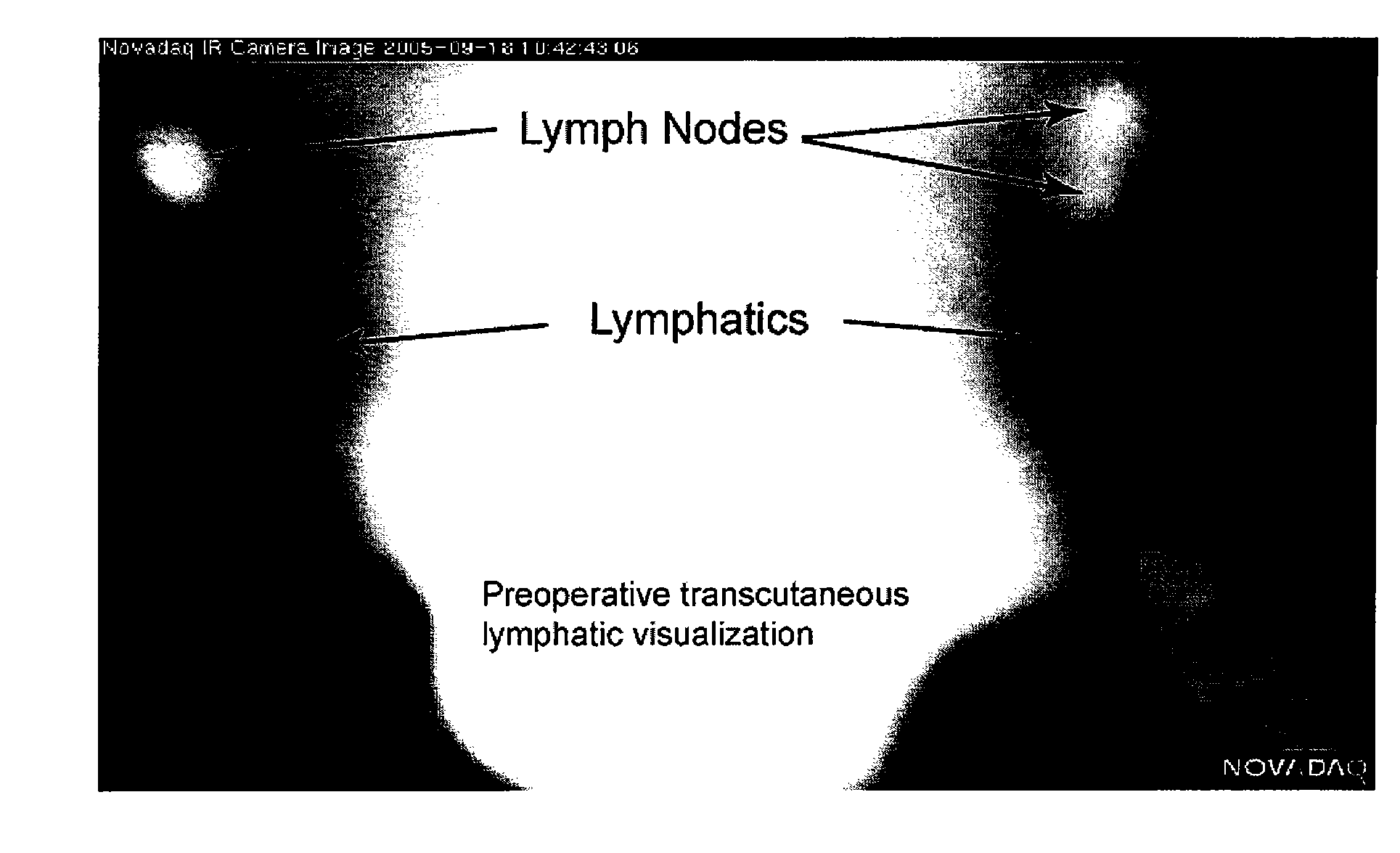 Pre-And Intra-Operative Localization of Penile Sentinel Nodes