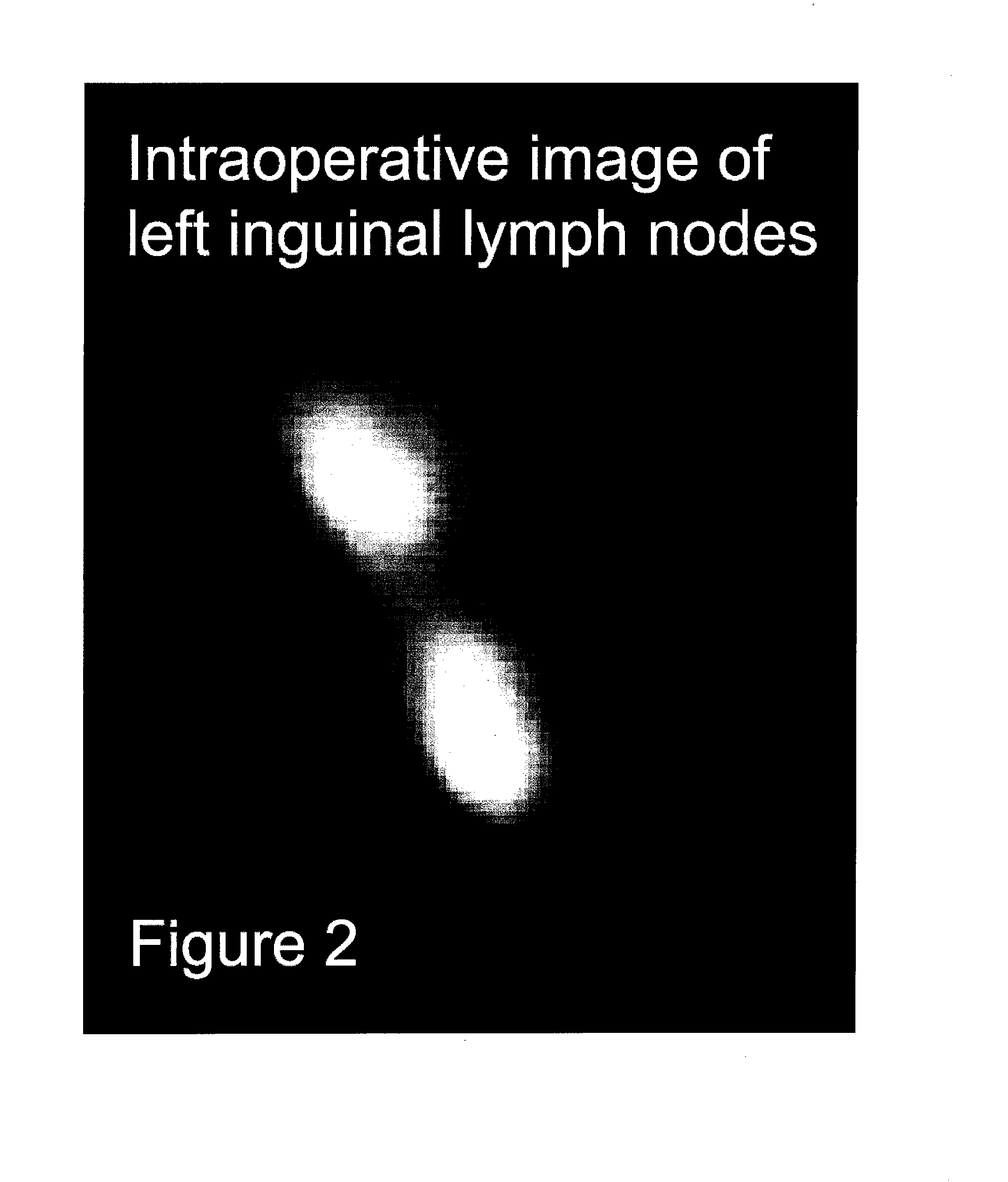 Pre-And Intra-Operative Localization of Penile Sentinel Nodes