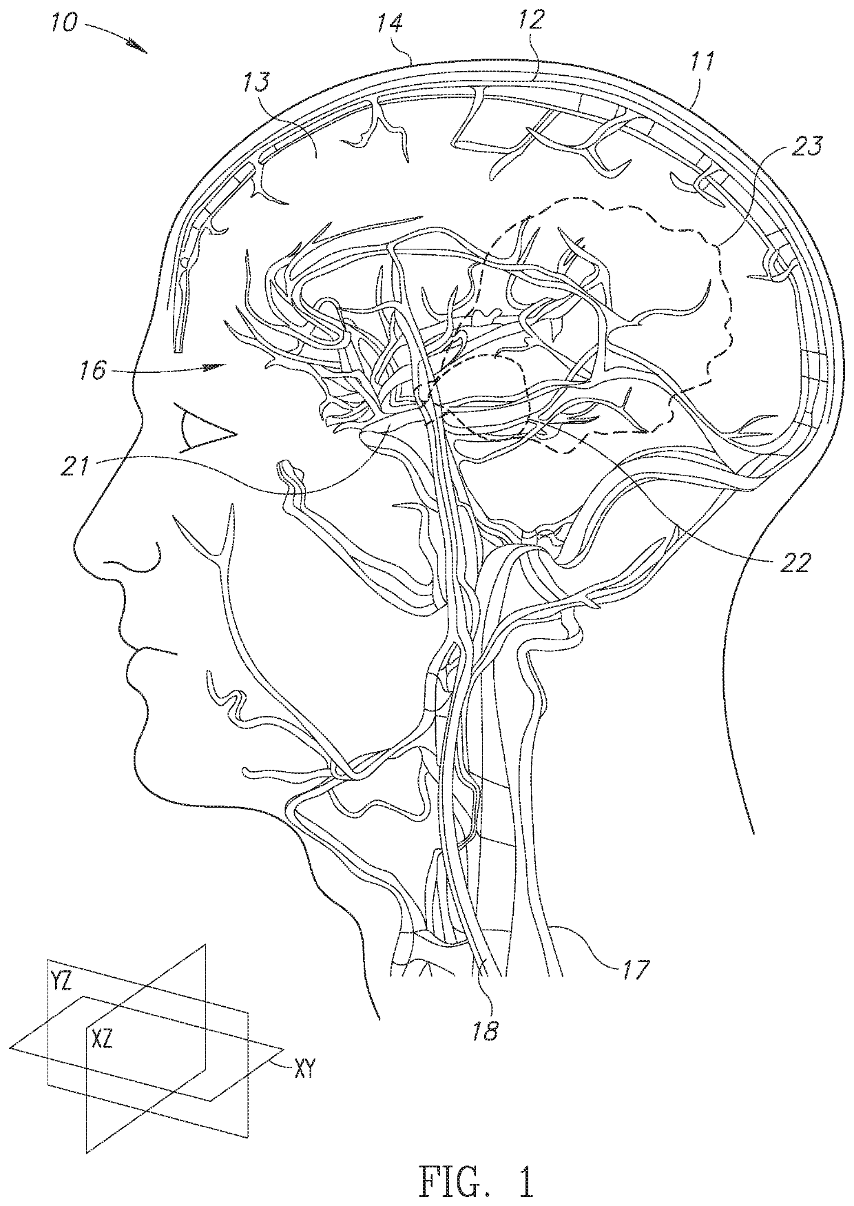 Neuroprotection apparatus