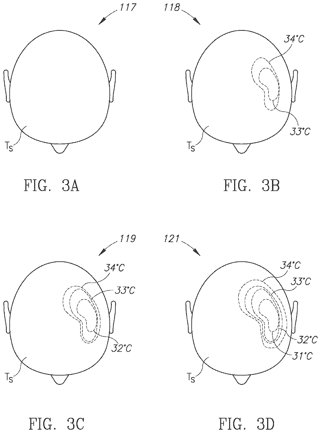 Neuroprotection apparatus