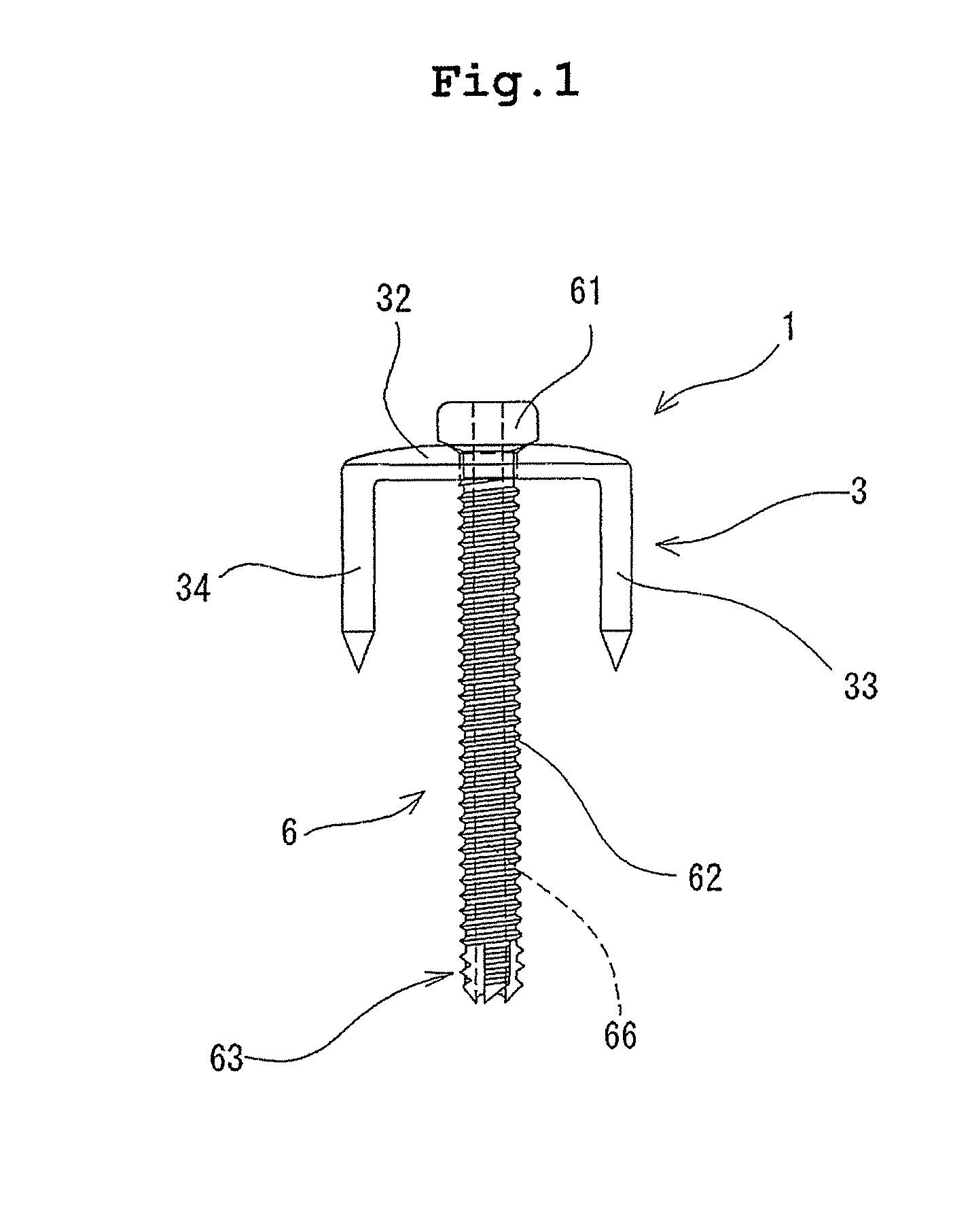 Tensile force-adjustable fixing tool for fixing tendon graft and ligament reconstruction method