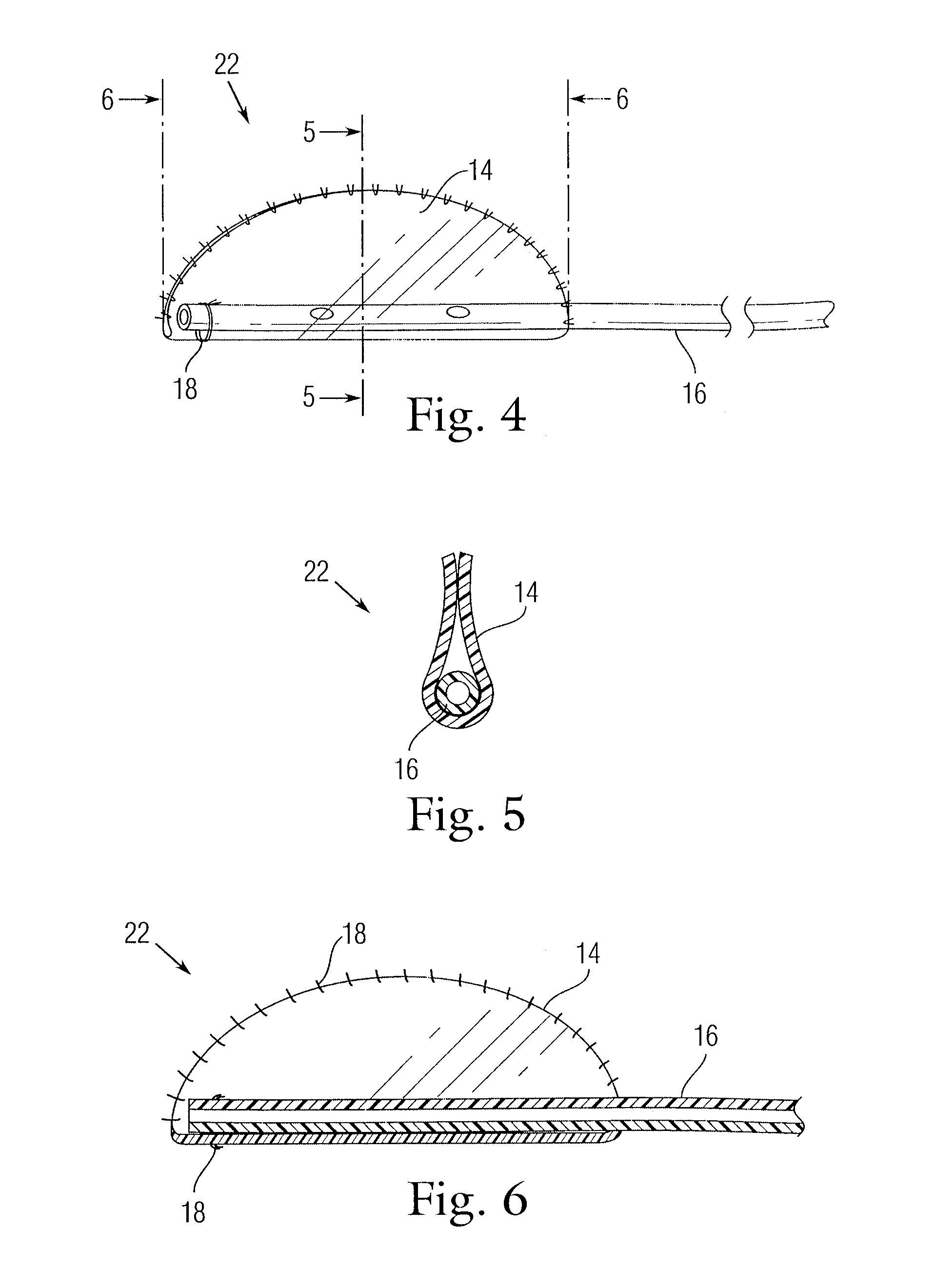 Implant for use in surgery for glaucoma and a method