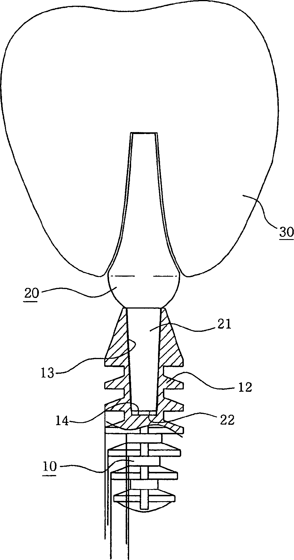 Dental implant fixture