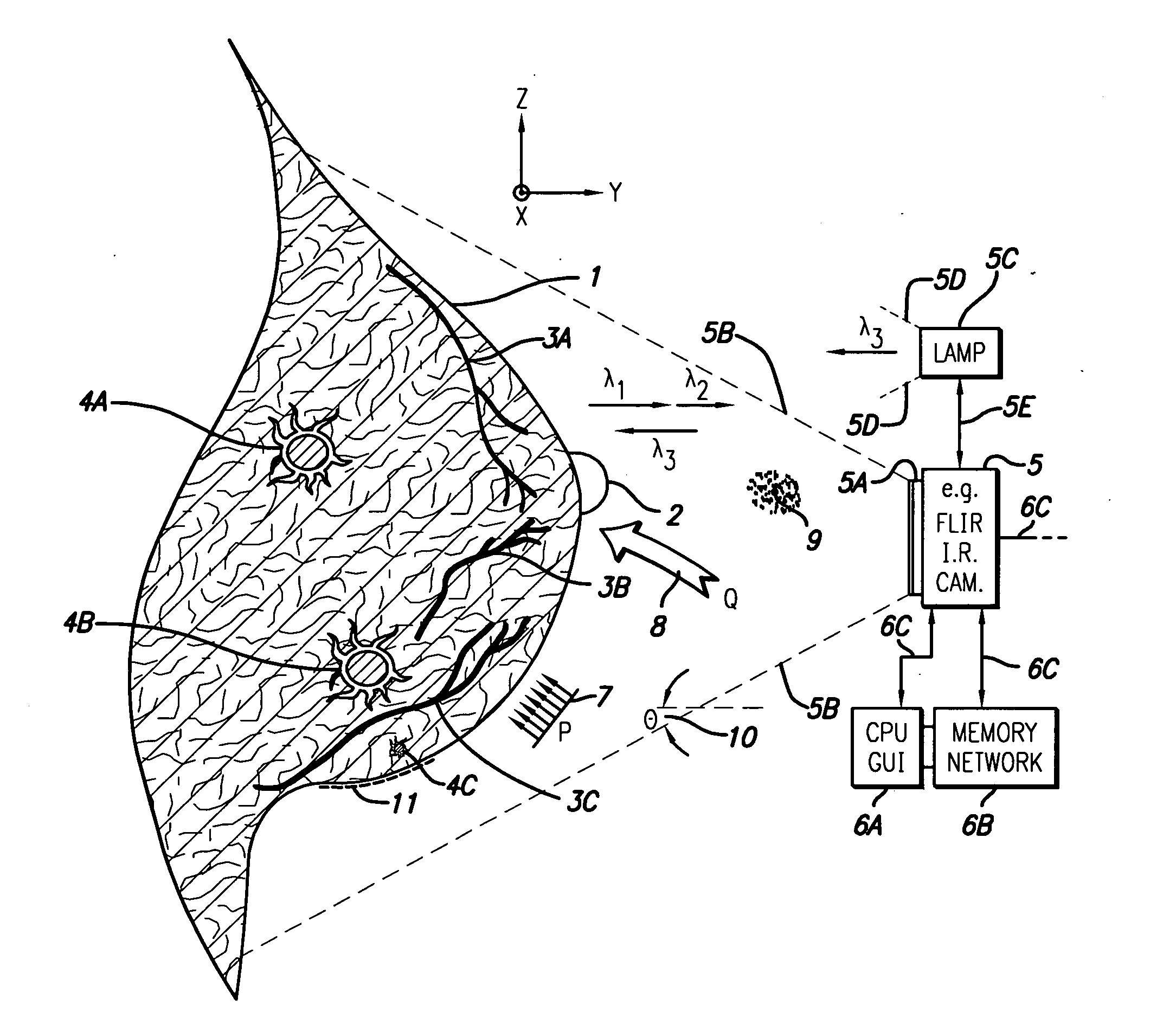 Infrared detection of cancerous tumors and other subsurface anomalies in the human breast and in other body parts